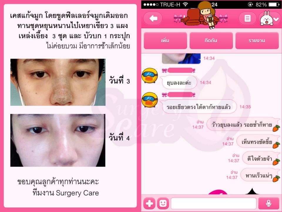 ทุบดั้ง,งัดดั้ง,รีวิวิเคสแก้จมูก,ทำจมูก,เสริมจมูก,แก้จมูก,รีวิวจมูก,รีวิวแก้จมูก,รีวิวเสริมจมูก,เหล่งเอี้ยง, เหล่งเอี้ยงextra, สมุนไพรจีน, ยาลดบวมช้ำศัลยกรรม, ลดปวด, ลดอักเสบ, สมานแผล, ทำศัยกรรมอยากหายไว, เหล่งเอี้ยงของแท้, เหล่งเอี้ยง, เหล่งเอี้ยงextra, แผลหายไว, พักฟื้น, เขียวช้ำ, ลดบวมซ้ำ, ฟื้นตัว, หายไว, ยาลดบวม, รีวิวดูดไขมัน,รีวิวทำหน้าวีเชฟ,รีวิวทุบหน้า, หยุนหนานไป๋เหยา, หยุนหนานไป๋เหยากล่องเขียว, Yunnanpaiyao, สมุนไพรจีน, ยาลดบวมช้ำศัลยกรรม, ทำศัยกรรมอยากหายไว, หยุนหนานไป๋หยาของแท้, Surgerycare,