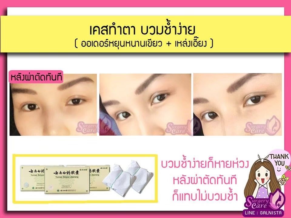 รีวิวทำตา ลูกค้าทานหยุนหนาไป๋เหยา เหล่งเอี๊ยง Extra