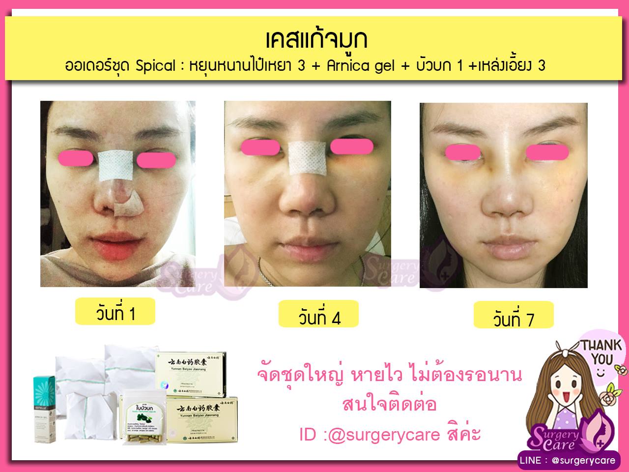 รีวิวแก้จมูก, รีวิวแก้จมูกOpen, รีวิวแก้จมูกกระดูกอ่อนหลังหู,เหล่งเอี้ยง,เหล่งเอี้ยงextra ,สมุนไพรจีน,ยาลดบวมช้ำศัลยกรรม, ลดปวด, ลดอักเสบ, สมานแผล, ทำศัยกรรมอยากหายไว, เหล่งเอี้ยงของแท้, เหล่งเอี้ยง, เหล่งเอี้ยงextra, แผลหายไว, พักฟื้นน้อย, เขียวช้ำ, ลดบวมซ้ำ,ฟื้นตัวไว, หายไว, ยาลดบวม, หยุนหนานไป๋เหยา, หยุนหนานไป๋เหยากล่องเขียว, Yunnanpaiyao,สมุนไพรจีน, ยาลดบวมช้ำศัลยกรรม, ทำศัยกรรมอยากหายไว, หยุนหนานไป๋หยาของแท้, Surgerycare,