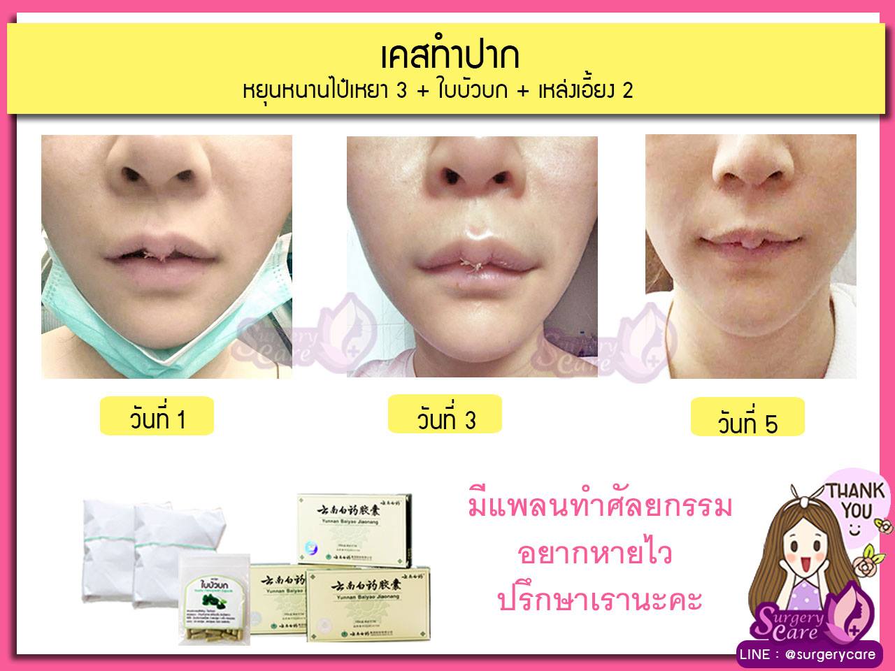 รีวิวตัดปาก,รีวิวทำปาก,รีวิวทำปากกระจับ, รีวิวหยุนหนานไป๋เหยา,รีวิวเหล่งเอี๊ยง,รีวิวสมุนไพร,รีวิวลดบวมช้ำ,รีวิวศัลยกรรม, รีวิวจมูก, รีวิวตา, รีวิวคาง , รีวิวเสริมหน้าอก, รีวิวดูดไขมัน, รีวิวศัลยกรรม, ฟิลเลอร์, ร้อยไหม, หยุนหนานไป๋เหยา ,Yunnanpaiyao, เหล่งเอี้ยงextra ,surgerycare, review, รีวิวผ่าตัด 