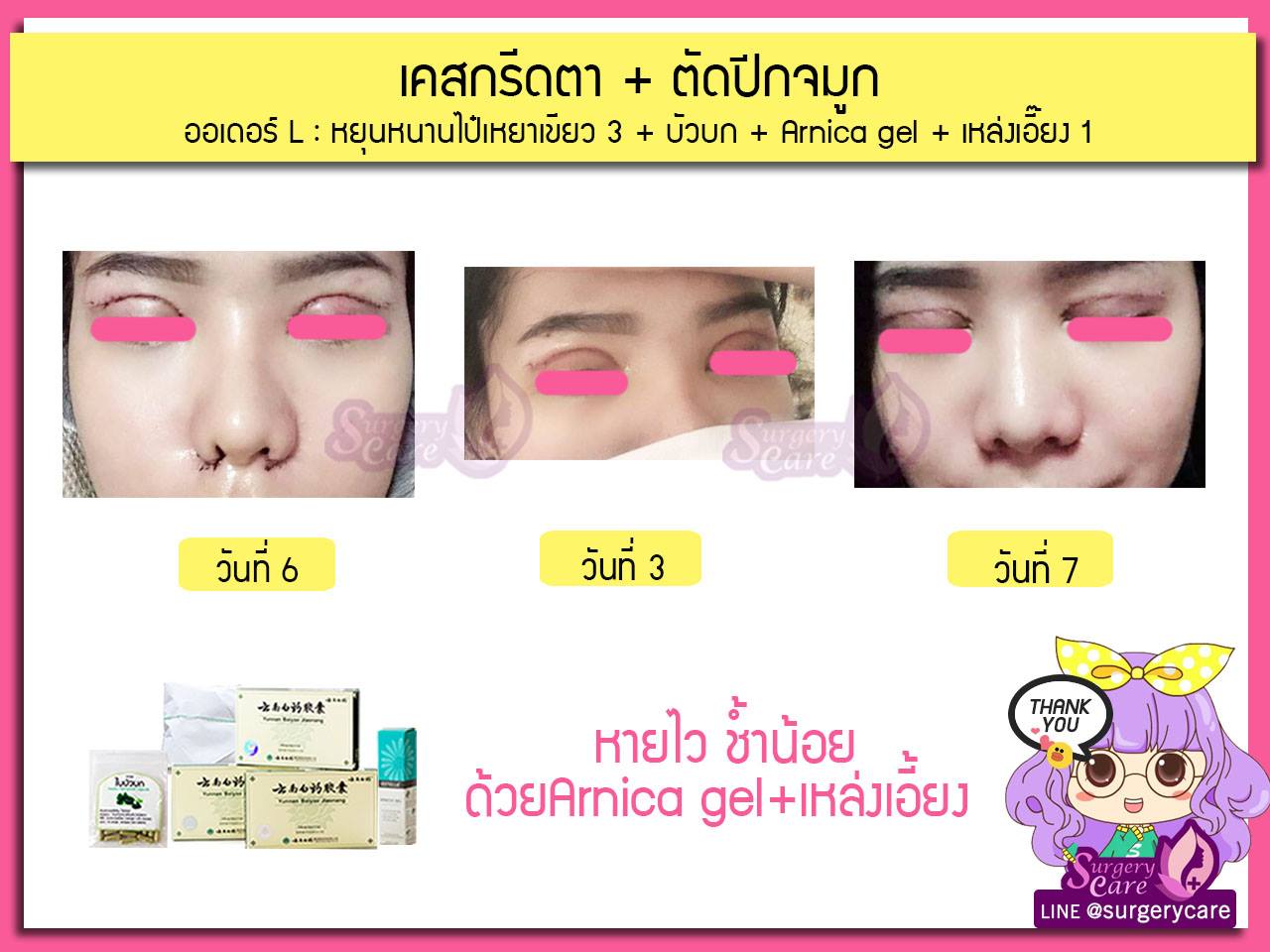รีวิวทำตา,รีวิวทำตาสองชั้น,รีวิวลดบวมช้ำ รีวิวศัลยกรรม,รีวิว, ศัลยกรรม, หยุนหนานไป๋เหยา, Yunnanpaiyao, เหล่งเอี้ยง, เหล่งเอี้ยงextra, surgerycare, review, รีวิวผ่าตัด