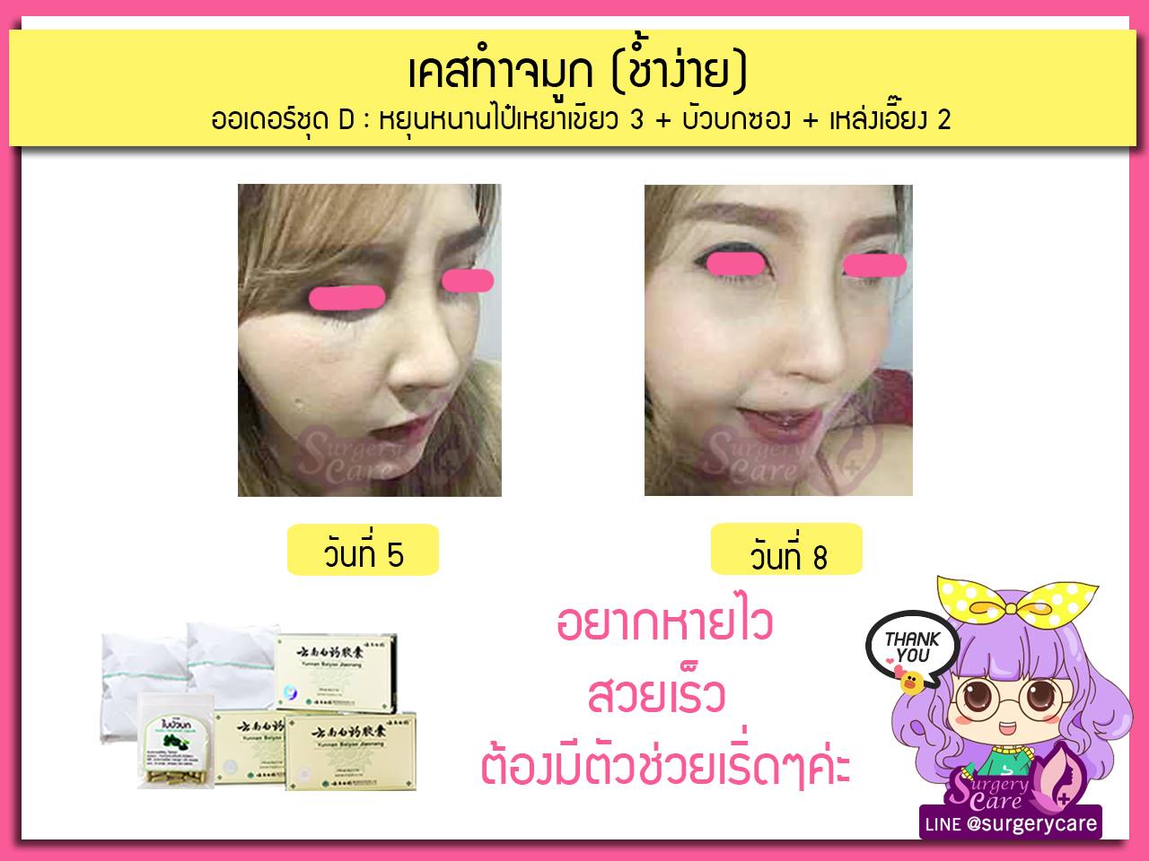 ทำจมูก,เสริมจมูก,งัดดั้ง,เสริมจมูก,รีวิวทำจมูก,รีวิวแก้จมูก,แก้จมูกOpen,รีวิวหยุนหนานไป๋เหยา รีวิวเหล่งเอี้ยง รีวิวสมุนไพร รีวิวบัวบก รีวิวลดบวมช้ำ รีวิวศัลยกรรม รีวิวจมูก รีวิวตา รีวิวคาง รีวิวปาก รีวิวเสริมหน้าอก รีวิวดูดไขมัน รีวิว ศัลยกรรม ฟิลเลอร์ ร้อยไหม หยุนหนานไป๋เหยา Yunnanpaiyao เหล่งเอี้ยง เหล่งเอี้ยงextra surgerycare