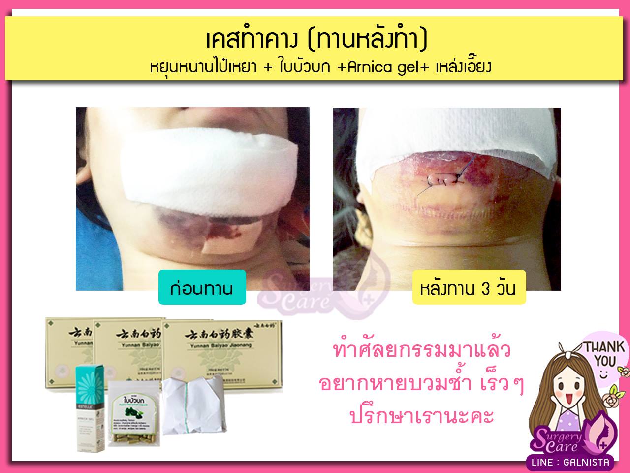 รีวิวจมูกทานหลังทำ,รีวิวทำคาง,เหล่งเอี้ยง,เหล่งเอี้ยงextra ,สมุนไพรจีน,ยาลดบวมช้ำศัลยกรรม, ลดปวด, ลดอักเสบ, สมานแผล, ทำศัยกรรมอยากหายไว, เหล่งเอี้ยงของแท้, เหล่งเอี้ยง, เหล่งเอี้ยงextra, แผลหายไว, พักฟื้นน้อย, เขียวช้ำ, ลดบวมซ้ำ,ฟื้นตัวไว, หายไว, ยาลดบวม, หยุนหนานไป๋เหยา, หยุนหนานไป๋เหยากล่องเขียว, Yunnanpaiyao,สมุนไพรจีน, ยาลดบวมช้ำศัลยกรรม, ทำศัยกรรมอยากหายไว, หยุนหนานไป๋หยาของแท้, Surgerycare,