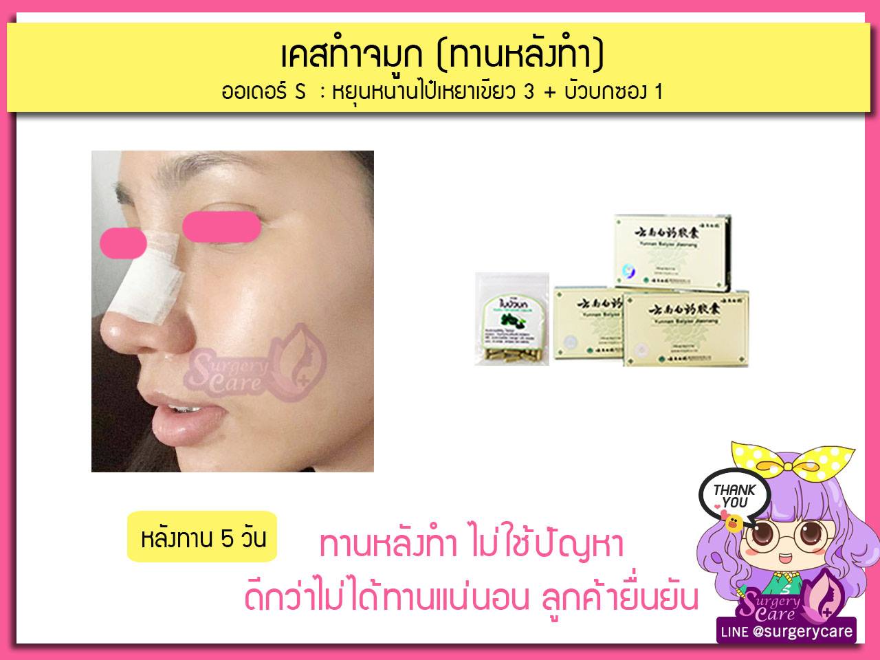 รีวิวทานหลังผ่าศัลยกรรม ผ่ามาแล้วบวมเขียวช้ำหายไว