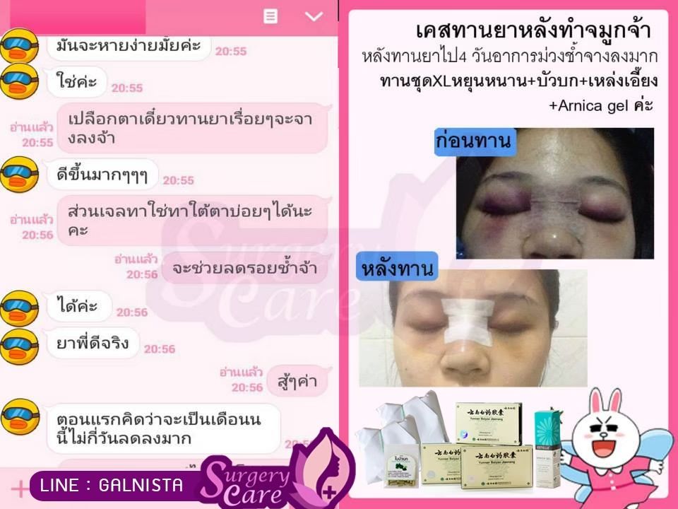 รีวิวทานหลังผ่าศัลยกรรม ผ่ามาแล้วบวมเขียวช้ำหายไว