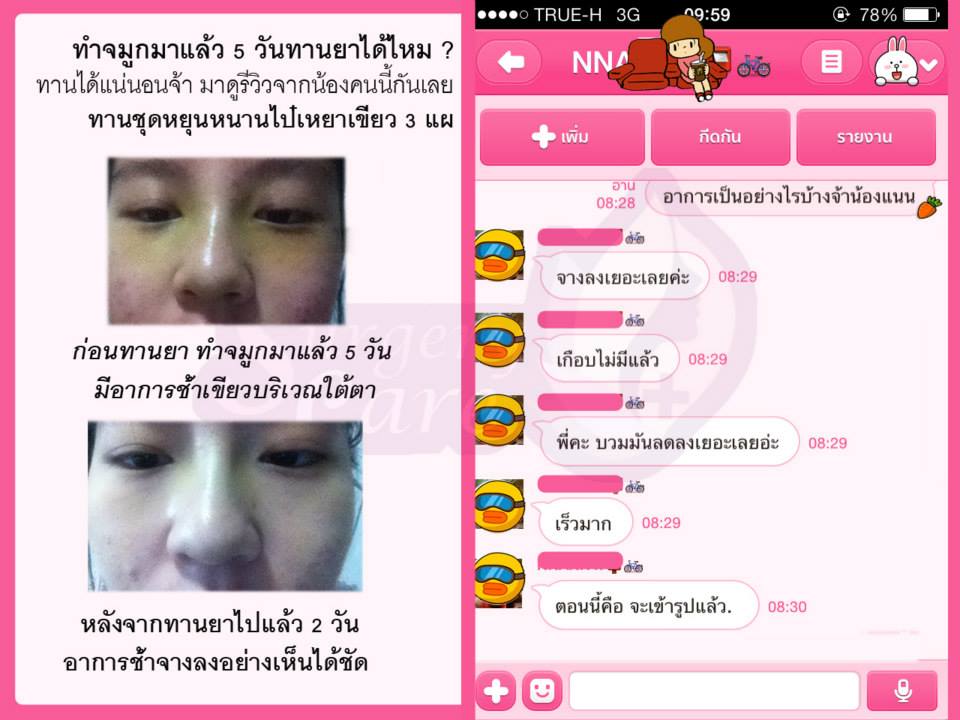 เคสทานหลังทำ,รีวิวทำจมูก,รีวิวแก้จมูก,รีวิวเสริมจมูก บวมช้ำน้อย,หายไว,เหล่งเอี้ยง,เหล่งเอี้ยงextra ,สมุนไพรจีน,ยาลดบวมช้ำศัลยกรรม, ลดปวด, ลดอักเสบ, สมานแผล, ทำศัยกรรมอยากหายไว, เหล่งเอี้ยงของแท้, เหล่งเอี้ยง, เหล่งเอี้ยงextra, แผลหายไว, พักฟื้นน้อย, เขียวช้ำ, ลดบวมซ้ำ,ฟื้นตัวไว, หายไว, ยาลดบวม, หยุนหนานไป๋เหยา, หยุนหนานไป๋เหยากล่องเขียว, Yunnanpaiyao,สมุนไพรจีน, ยาลดบวมช้ำศัลยกรรม, ทำศัยกรรมอยากหายไว, หยุนหนานไป๋หยาของแท้, Surgerycare,