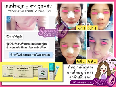 รีวิวหยุนหนานไป๋เหยา ,รีวิวเหล่งเอี้ยง ,รีวิวสมุนไพร ,รีวิวลดบวมช้ำ ,รีวิวศัลยกรรม ,รีวิวจมูก ,รีวิวตา ,รีวิวคาง ,รีวิวปาก ,รีวิวเสริมหน้าอก ,รีวิวดูดไขมัน ,รีวิว ,ศัลยกรรม ,ฟิลเลอร์ ,ร้อยไหม ,หยุนหนานไป๋เหยา ,Yunnanpaiyao ,เหล่งเอี้ยง ,เหล่งเอี้ยงextra ,surgerycare ,review ,รีวิวผ่าตัด 