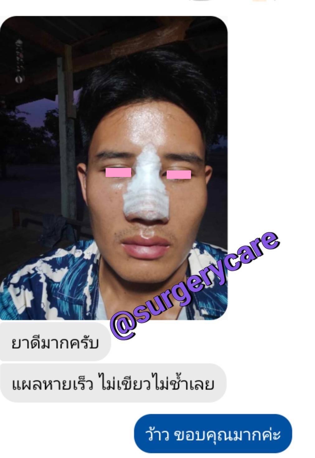 รีวิวหยุนหนานไป๋เหยา ,รีวิวเหล่งเอี้ยง ,รีวิวสมุนไพร ,รีวิวลดบวมช้ำ ,รีวิวศัลยกรรม ,รีวิวจมูก ,รีวิวตา ,รีวิวคาง ,รีวิวปาก ,รีวิวเสริมหน้าอก ,รีวิวดูดไขมัน ,รีวิว ,ศัลยกรรม ,ฟิลเลอร์ ,ร้อยไหม ,หยุนหนานไป๋เหยา ,Yunnanpaiyao ,เหล่งเอี้ยง ,เหล่งเอี้ยงextra ,surgerycare ,review ,รีวิวผ่าตัด ขายหยุนหนานไป๋เหยา