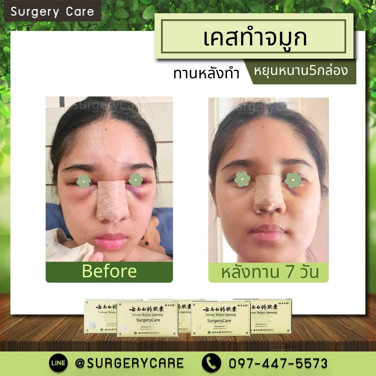 รีวิวทำจมูก รีวิวหยุนหนานไป๋เหยา เหล่งเอี๊ยงExtra 2