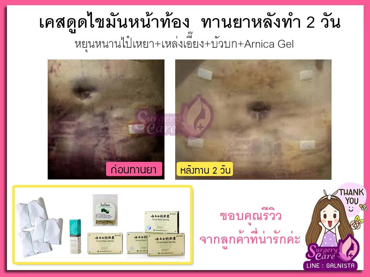 รีวิวดูดไขมันหน้าท้อง,รีวิวดูดไขมัน,เหล่งเอี้ยง, เหล่งเอี้ยงextra, สมุนไพรจีน, ยาลดบวมช้ำศัลยกรรม, ลดปวด, ลดอักเสบ, สมานแผล, ทำศัยกรรมอยากหายไว, เหล่งเอี้ยงของแท้, เหล่งเอี้ยง, เหล่งเอี้ยงextra, แผลหายไว, พักฟื้น, เขียวช้ำ, ลดบวมซ้ำ, ฟื้นตัว, หายไว, ยาลดบวม, รีวิวดูดไขมัน, หยุนหนานไป๋เหยา, หยุนหนานไป๋เหยากล่องเขียว, Yunnanpaiyao, สมุนไพรจีน, ยาลดบวมช้ำศัลยกรรม, ทำศัยกรรมอยากหายไว, หยุนหนานไป๋หยาของแท้, Surgerycare,