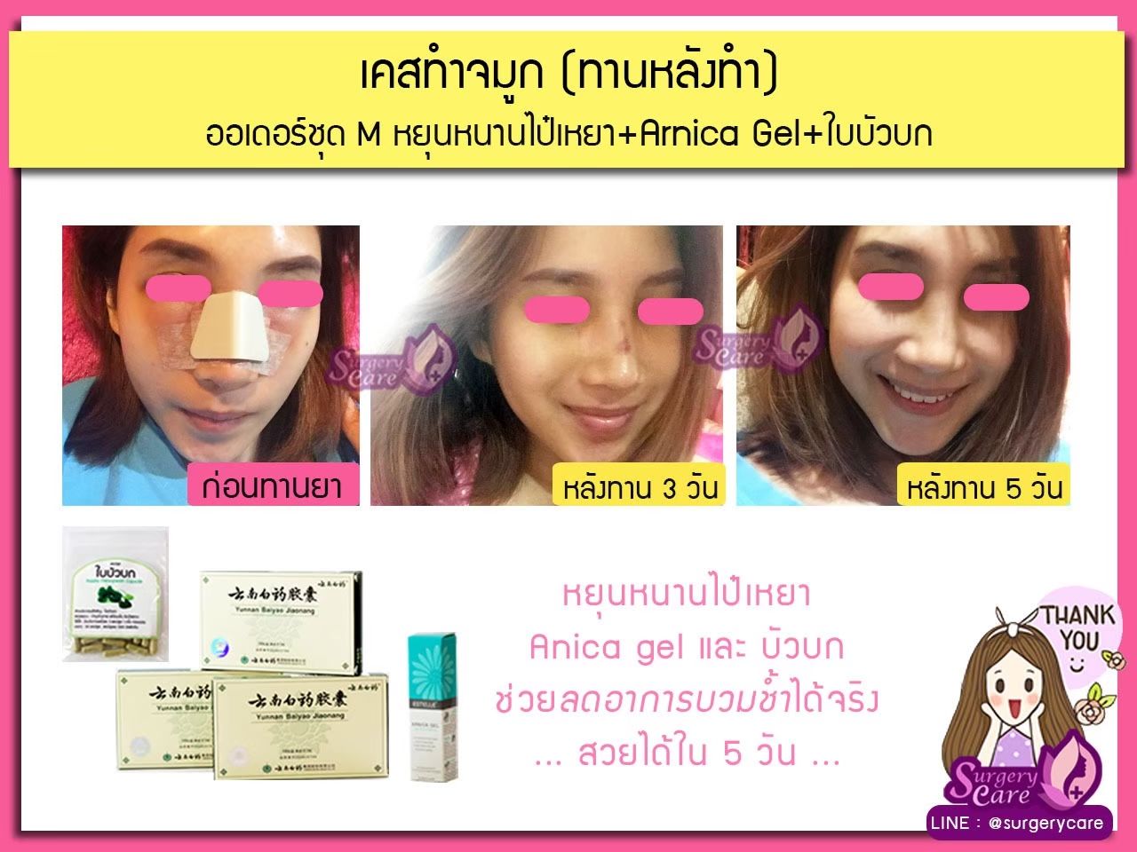 รีวิวทานหลังผ่าศัลยกรรม ผ่ามาแล้วบวมเขียวช้ำหายไว
