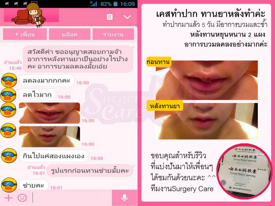 รีวิวทำปาก รีวิวหยุนหนานไป๋เหยา,รีวิวเหล่งเอี๊ยง,รีวิวสมุนไพร,รีวิวลดบวมช้ำ,รีวิวศัลยกรรม, รีวิวจมูก, รีวิวตา, รีวิวคาง , รีวิวเสริมหน้าอก, รีวิวดูดไขมัน, รีวิวศัลยกรรม, ฟิลเลอร์, ร้อยไหม, หยุนหนานไป๋เหยา ,Yunnanpaiyao, เหล่งเอี้ยงextra ,surgerycare, review, รีวิวผ่าตัด 