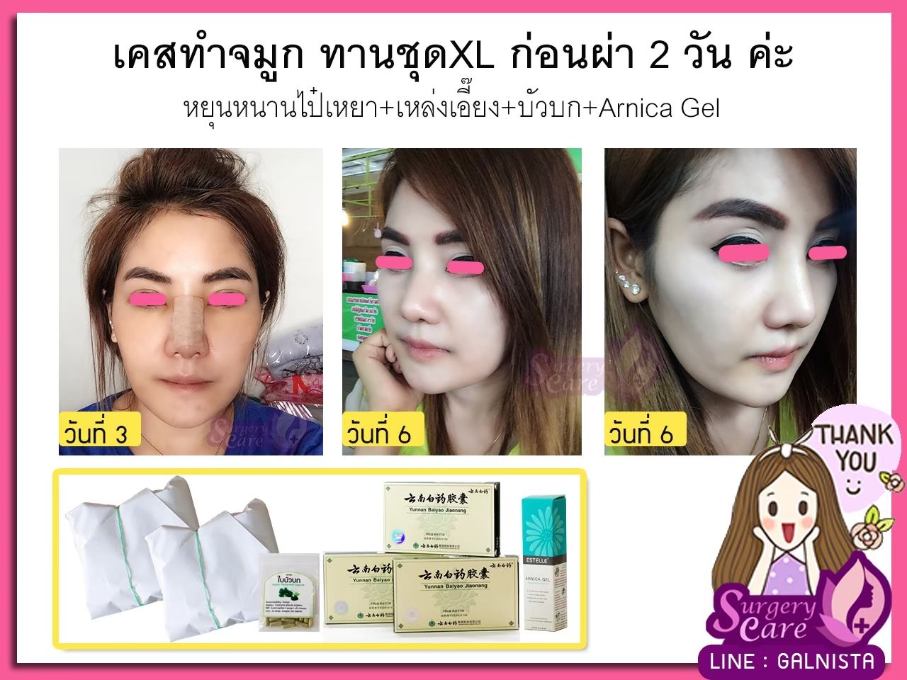 รีวิวทำจมูก,รีวิวแก้จมูก,แก้จมูกOpen,รีวิวหยุนหนานไป๋เหยา รีวิวเหล่งเอี้ยง รีวิวสมุนไพร รีวิวบัวบก รีวิวลดบวมช้ำ รีวิวศัลยกรรม รีวิวจมูก รีวิวตา รีวิวคาง รีวิวปาก รีวิวเสริมหน้าอก รีวิวดูดไขมัน รีวิว ศัลยกรรม ฟิลเลอร์ ร้อยไหม หยุนหนานไป๋เหยา Yunnanpaiyao เหล่งเอี้ยง เหล่งเอี้ยงextra surgerycare