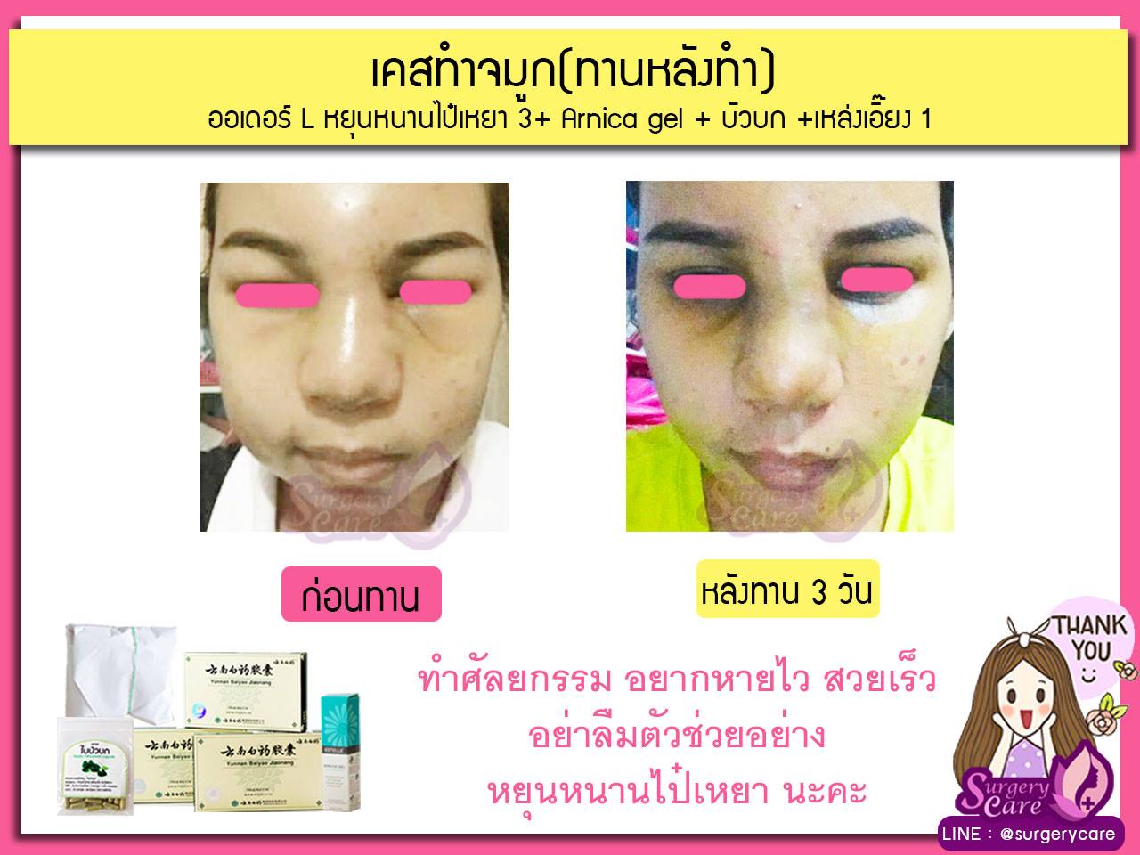 รีวิวจมูกทานหลังทำ,รีวิวจมูก,เหล่งเอี้ยง,เหล่งเอี้ยงextra ,สมุนไพรจีน,ยาลดบวมช้ำศัลยกรรม, ลดปวด, ลดอักเสบ, สมานแผล, ทำศัยกรรมอยากหายไว, เหล่งเอี้ยงของแท้, เหล่งเอี้ยง, เหล่งเอี้ยงextra, แผลหายไว, พักฟื้นน้อย, เขียวช้ำ, ลดบวมซ้ำ,ฟื้นตัวไว, หายไว, ยาลดบวม, หยุนหนานไป๋เหยา, หยุนหนานไป๋เหยากล่องเขียว, Yunnanpaiyao,สมุนไพรจีน, ยาลดบวมช้ำศัลยกรรม, ทำศัยกรรมอยากหายไว, หยุนหนานไป๋หยาของแท้, Surgerycare,