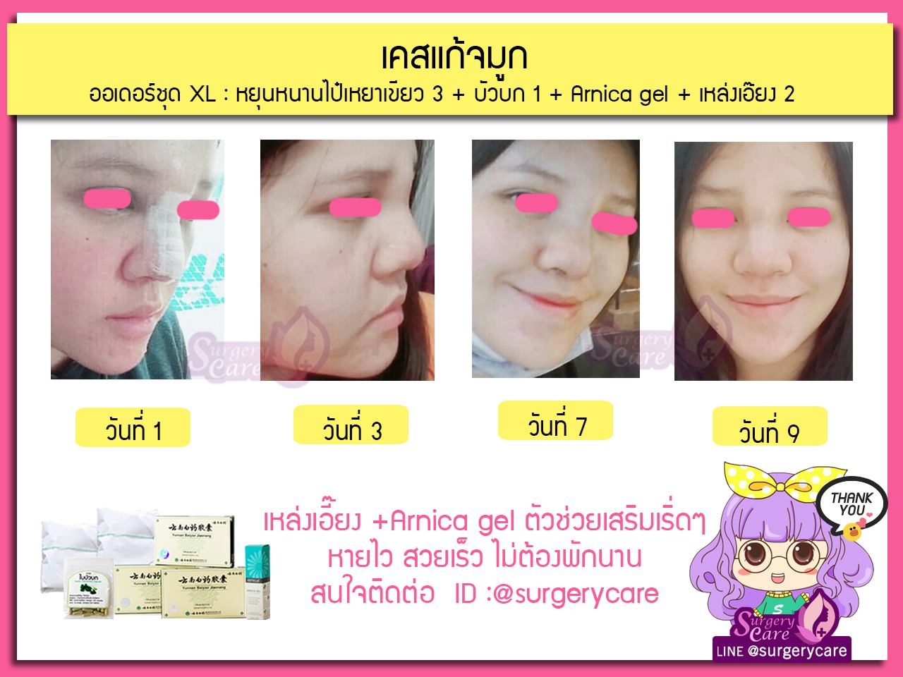 ทำจมูก,แก้จมูก,เสริมดั้ง,งัดดั้ง,รีวิวแก้จมูก, รีวิวแก้จมูกOpen, รีวิวแก้จมูกกระดูกอ่อนหลังหู,เหล่งเอี้ยง,เหล่งเอี้ยงextra ,สมุนไพรจีน,ยาลดบวมช้ำศัลยกรรม, ลดปวด, ลดอักเสบ, สมานแผล, ทำศัยกรรมอยากหายไว, เหล่งเอี้ยงของแท้, เหล่งเอี้ยง, เหล่งเอี้ยงextra, แผลหายไว, พักฟื้นน้อย, เขียวช้ำ, ลดบวมซ้ำ,ฟื้นตัวไว, หายไว, ยาลดบวม, หยุนหนานไป๋เหยา, หยุนหนานไป๋เหยากล่องเขียว, Yunnanpaiyao,สมุนไพรจีน, ยาลดบวมช้ำศัลยกรรม, ทำศัยกรรมอยากหายไว, หยุนหนานไป๋หยาของแท้, Surgerycare,