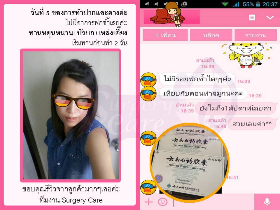 ทำปาก,รีวิวตัดปาก,รีวิวทำปาก,รีวิวทำปากกระจับ, รีวิวหยุนหนานไป๋เหยา,รีวิวเหล่งเอี๊ยง,รีวิวสมุนไพร,รีวิวลดบวมช้ำ,รีวิวศัลยกรรม, รีวิวจมูก, รีวิวตา, รีวิวคาง , รีวิวเสริมหน้าอก, รีวิวดูดไขมัน, รีวิวศัลยกรรม, ฟิลเลอร์, ร้อยไหม, หยุนหนานไป๋เหยา ,Yunnanpaiyao, เหล่งเอี้ยงextra ,surgerycare, review, รีวิวผ่าตัด 