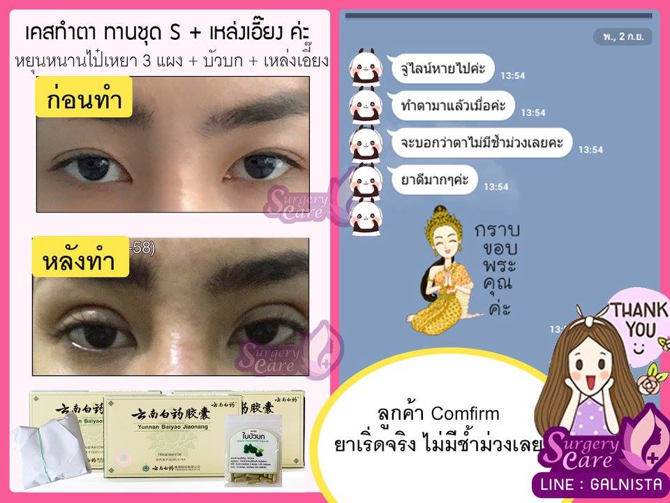 รีวิวทำตา,แก้ตา,ทำตา,ตา2ชั้น,รีวิวศัลยกรรมตา2ชั้น,รีวิวผ่าตา,รีวิวทำตา,รีวิวทำตาสองชั้น,รีวิวลดบวมช้ำ รีวิวศัลยกรรม,รีวิว, ศัลยกรรม, หยุนหนานไป๋เหยา, Yunnanpaiyao, เหล่งเอี้ยง, เหล่งเอี้ยงextra, surgerycare, review, รีวิวผ่าตัด