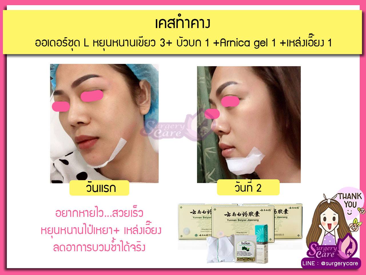 รีวิวทำคาง,รีวิวเสริมคาง,เหล่งเอี้ยง, เหล่งเอี้ยงextra, สมุนไพรจีน, ยาลดบวมช้ำศัลยกรรม, ลดปวด, ลดอักเสบ, สมานแผล, ทำศัยกรรมอยากหายไว, เหล่งเอี้ยงของแท้ ,เหล่งเอี้ยง, เหล่งเอี้ยงextra, แผลหายไว, พักฟื้น, เขียวช้ำ, ลดบวมซ้ำ, ฟื้นตัว, หายไว, ยาลดบวม, หยุนหนานไป๋เหยา, หยุนหนานไป๋เหยากล่องเขียว, Yunnanpaiyao, สมุนไพรจีน, ยาลดบวมช้ำ,ศัลยกรรม, ทำศัยกรรมอยากหายไว, หยุนหนานไป๋หยาของแท้, Surgerycare,