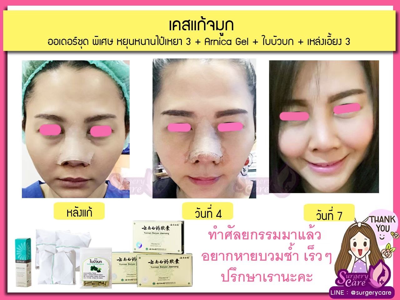 รีวิวแก้จมูก, รีวิวแก้จมูกOpen, รีวิวแก้จมูกกระดูกอ่อนหลังหู,เหล่งเอี้ยง,เหล่งเอี้ยงextra ,สมุนไพรจีน,ยาลดบวมช้ำศัลยกรรม, ลดปวด, ลดอักเสบ, สมานแผล, ทำศัยกรรมอยากหายไว, เหล่งเอี้ยงของแท้, เหล่งเอี้ยง, เหล่งเอี้ยงextra, แผลหายไว, พักฟื้นน้อย, เขียวช้ำ, ลดบวมซ้ำ,ฟื้นตัวไว, หายไว, ยาลดบวม, หยุนหนานไป๋เหยา, หยุนหนานไป๋เหยากล่องเขียว, Yunnanpaiyao,สมุนไพรจีน, ยาลดบวมช้ำศัลยกรรม, ทำศัยกรรมอยากหายไว, หยุนหนานไป๋หยาของแท้, Surgerycare,