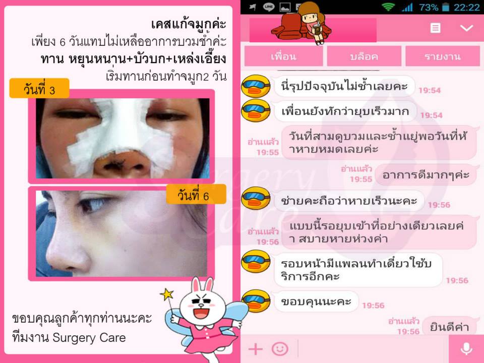 รีวิวแก้จมูก,รีวิวเสริมจมูก, รีวิวแก้จมูกOpen,บวมช้ำน้อย,หายไว, รีวิวแก้จมูกกระดูกอ่อนหลังหู,เหล่งเอี้ยง,เหล่งเอี้ยงextra ,สมุนไพรจีน,ยาลดบวมช้ำศัลยกรรม, ลดปวด, ลดอักเสบ, สมานแผล, ทำศัยกรรมอยากหายไว, เหล่งเอี้ยงของแท้, เหล่งเอี้ยง, เหล่งเอี้ยงextra, แผลหายไว, พักฟื้นน้อย, เขียวช้ำ, ลดบวมซ้ำ,ฟื้นตัวไว, หายไว, ยาลดบวม, หยุนหนานไป๋เหยา, หยุนหนานไป๋เหยากล่องเขียว, Yunnanpaiyao,สมุนไพรจีน, ยาลดบวมช้ำศัลยกรรม, ทำศัยกรรมอยากหายไว, หยุนหนานไป๋หยาของแท้, Surgerycare,