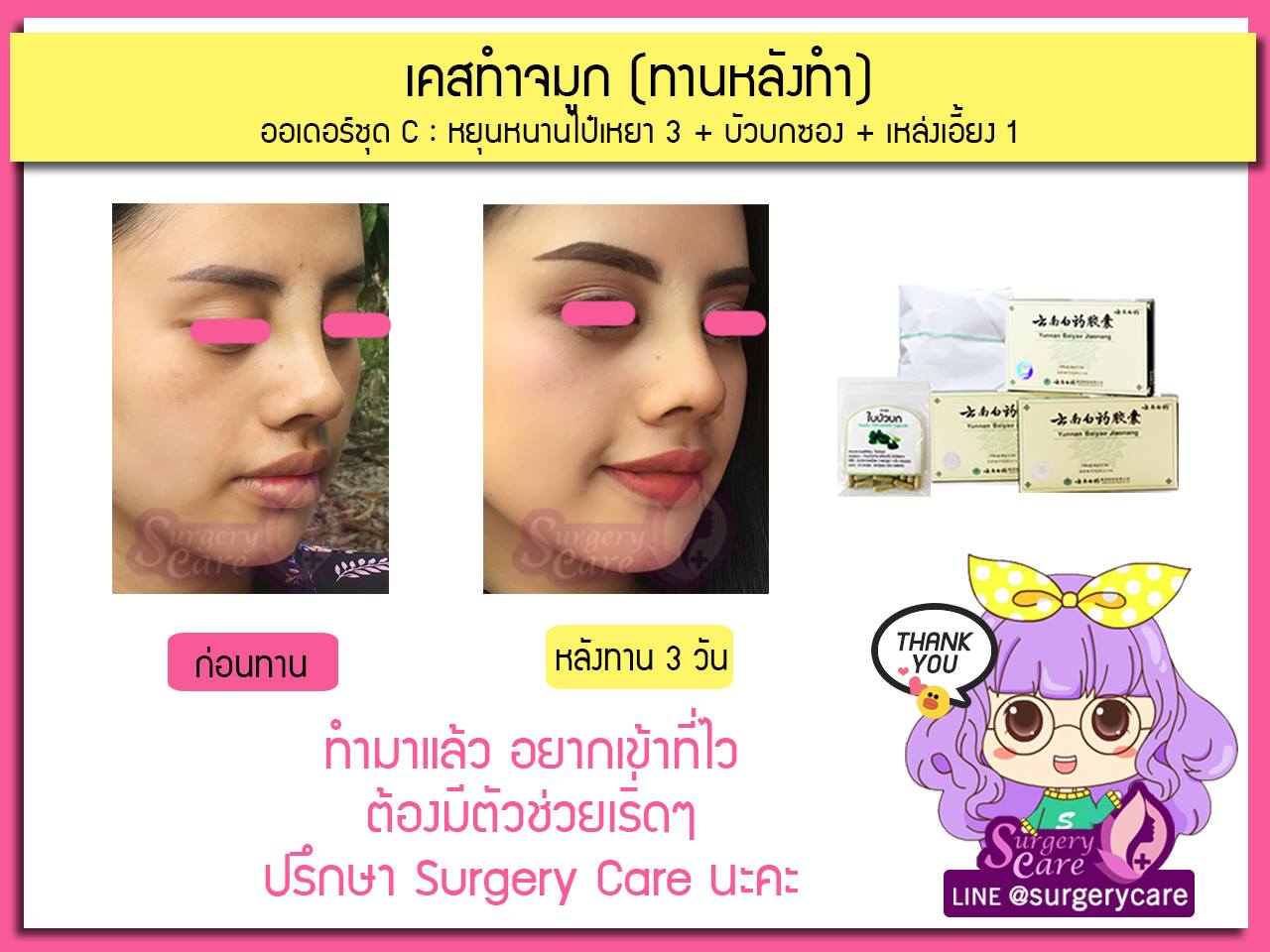 รีวิวจมูกทานหลังทำ,รีวิวจมูก,เหล่งเอี้ยง,เหล่งเอี้ยงextra ,สมุนไพรจีน,ยาลดบวมช้ำศัลยกรรม, ลดปวด, ลดอักเสบ, สมานแผล, ทำศัยกรรมอยากหายไว, เหล่งเอี้ยงของแท้, เหล่งเอี้ยง, เหล่งเอี้ยงextra, แผลหายไว, พักฟื้นน้อย, เขียวช้ำ, ลดบวมซ้ำ,ฟื้นตัวไว, หายไว, ยาลดบวม, หยุนหนานไป๋เหยา, หยุนหนานไป๋เหยากล่องเขียว, Yunnanpaiyao,สมุนไพรจีน, ยาลดบวมช้ำศัลยกรรม, ทำศัยกรรมอยากหายไว, หยุนหนานไป๋หยาของแท้, Surgerycare,