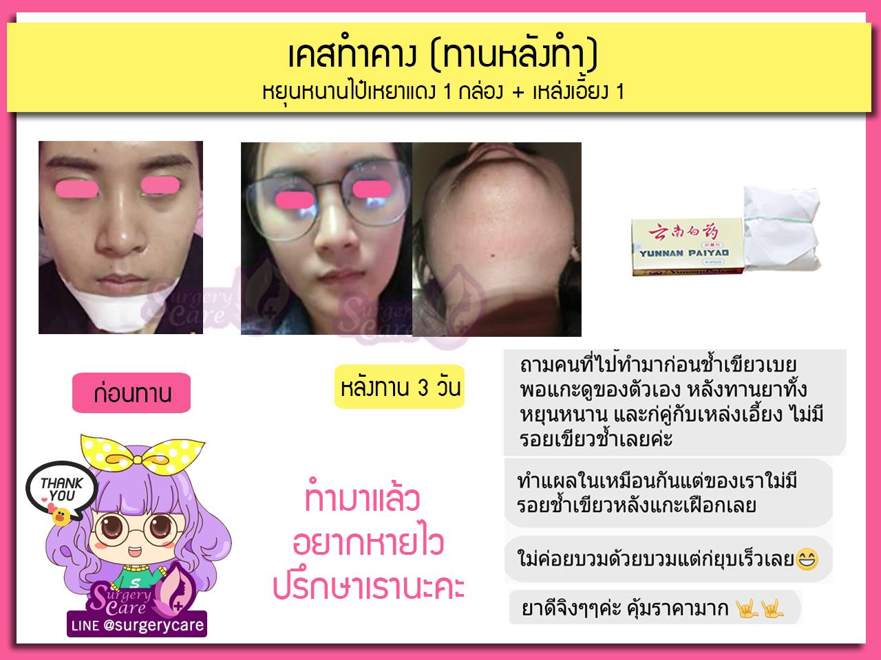 เคสทานหลังทำ,รีวิวทำคาง,รีวิวแก้คาง,รีวิวเสริมคาง,บวมช้ำน้อย,หายไว,เหล่งเอี้ยง,เหล่งเอี้ยงextra ,สมุนไพรจีน,ยาลดบวมช้ำศัลยกรรม, ลดปวด, ลดอักเสบ, สมานแผล, ทำศัยกรรมอยากหายไว, เหล่งเอี้ยงของแท้, เหล่งเอี้ยง, เหล่งเอี้ยงextra, แผลหายไว, พักฟื้นน้อย, เขียวช้ำ, ลดบวมซ้ำ,ฟื้นตัวไว, หายไว, ยาลดบวม, หยุนหนานไป๋เหยา, หยุนหนานไป๋เหยากล่องเขียว, Yunnanpaiyao,สมุนไพรจีน, ยาลดบวมช้ำศัลยกรรม, ทำศัยกรรมอยากหายไว, หยุนหนานไป๋หยาของแท้, Surgerycare,