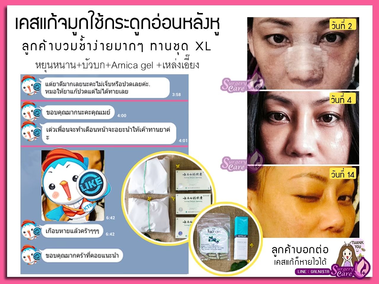 รีวิวแก้จมูก ลูกค้าทานสมุนไพรหยุนหนานไป๋เหยากับเหล่งเอี๊ยงExtra
