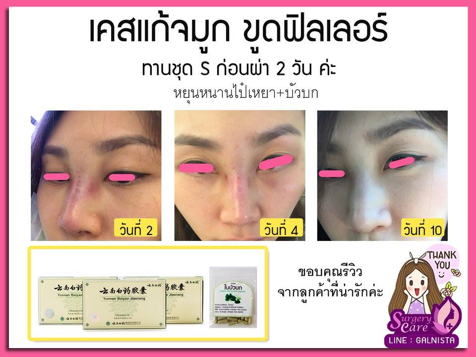 เคสแก้,ขูดฟิลเลอร์,รีวิวแก้จมูก,รีวิวเสริมจมูก, รีวิวแก้จมูกOpen,บวมช้ำน้อย,หายไว, รีวิวแก้จมูกกระดูกอ่อนหลังหู,เหล่งเอี้ยง,เหล่งเอี้ยงextra ,สมุนไพรจีน,ยาลดบวมช้ำศัลยกรรม, ลดปวด, ลดอักเสบ, สมานแผล, ทำศัยกรรมอยากหายไว, เหล่งเอี้ยงของแท้, เหล่งเอี้ยง, เหล่งเอี้ยงextra, แผลหายไว, พักฟื้นน้อย, เขียวช้ำ, ลดบวมซ้ำ,ฟื้นตัวไว, หายไว, ยาลดบวม, หยุนหนานไป๋เหยา, หยุนหนานไป๋เหยากล่องเขียว, Yunnanpaiyao,สมุนไพรจีน, ยาลดบวมช้ำศัลยกรรม, ทำศัยกรรมอยากหายไว, หยุนหนานไป๋หยาของแท้, Surgerycare,