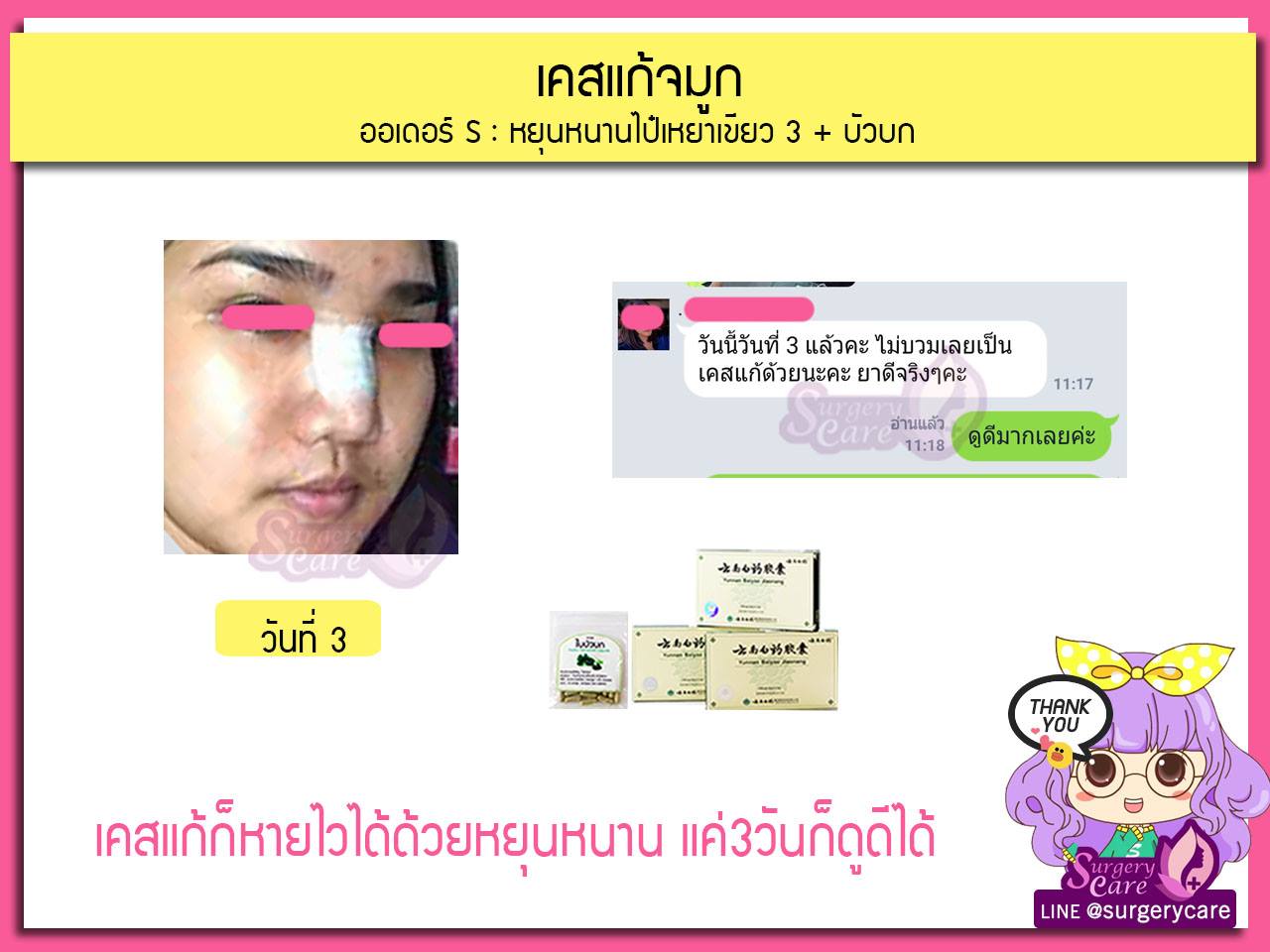 รีวิวแก้จมูก, รีวิวแก้จมูกOpen, รีวิวแก้จมูกกระดูกอ่อนหลังหู,เหล่งเอี้ยง,เหล่งเอี้ยงextra ,สมุนไพรจีน,ยาลดบวมช้ำศัลยกรรม, ลดปวด, ลดอักเสบ, สมานแผล, ทำศัยกรรมอยากหายไว, เหล่งเอี้ยงของแท้, เหล่งเอี้ยง, เหล่งเอี้ยงextra, แผลหายไว, พักฟื้นน้อย, เขียวช้ำ, ลดบวมซ้ำ,ฟื้นตัวไว, หายไว, ยาลดบวม, หยุนหนานไป๋เหยา, หยุนหนานไป๋เหยากล่องเขียว, Yunnanpaiyao,สมุนไพรจีน, ยาลดบวมช้ำศัลยกรรม, ทำศัยกรรมอยากหายไว, หยุนหนานไป๋หยาของแท้, Surgerycare,