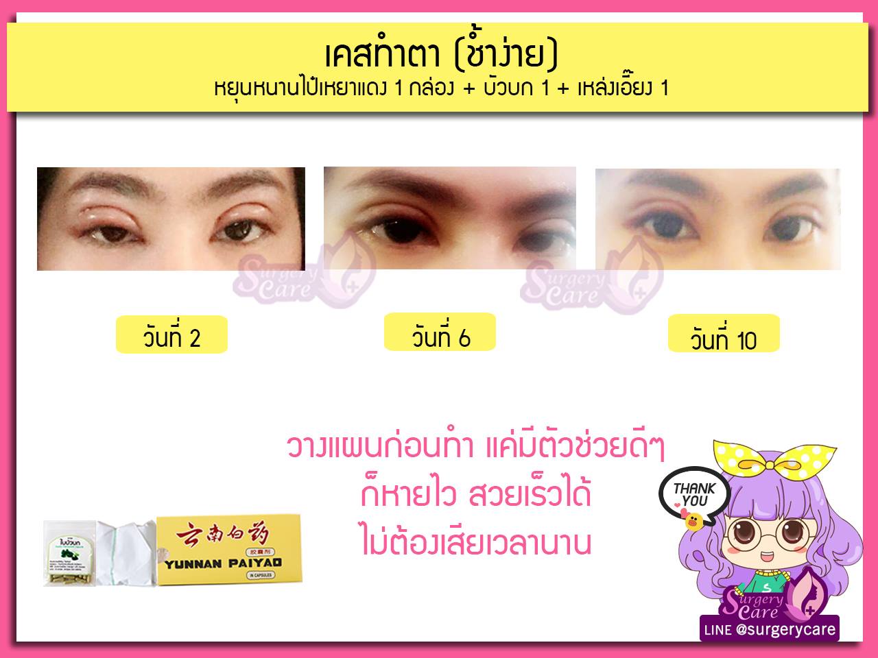 รีวิวทำตา,แก้ตา,ทำตา,ตา2ชั้น,รีวิวศัลยกรรมตา2ชั้น,รีวิวผ่าตา,รีวิวทำตา,รีวิวทำตาสองชั้น,รีวิวลดบวมช้ำ รีวิวศัลยกรรม,รีวิว, ศัลยกรรม, หยุนหนานไป๋เหยา, Yunnanpaiyao, เหล่งเอี้ยง, เหล่งเอี้ยงextra, surgerycare, review, รีวิวผ่าตัด