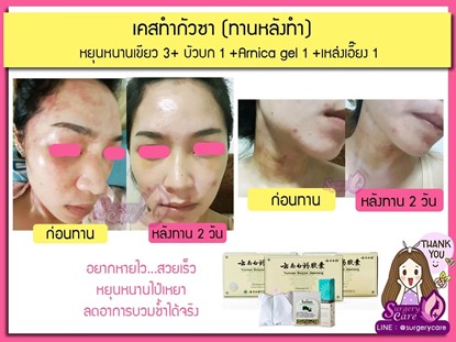 รีวิวหยุนหนานไป๋เหยา ,รีวิวเหล่งเอี้ยง ,รีวิวสมุนไพร ,รีวิวลดบวมช้ำ ,รีวิวศัลยกรรม ,รีวิวจมูก ,รีวิวตา ,รีวิวคาง ,รีวิวปาก ,รีวิวเสริมหน้าอก ,รีวิวดูดไขมัน ,รีวิว ,ศัลยกรรม ,ฟิลเลอร์ ,ร้อยไหม ,หยุนหนานไป๋เหยา ,Yunnanpaiyao ,เหล่งเอี้ยง ,เหล่งเอี้ยงextra ,surgerycare ,review ,รีวิวผ่าตัด 