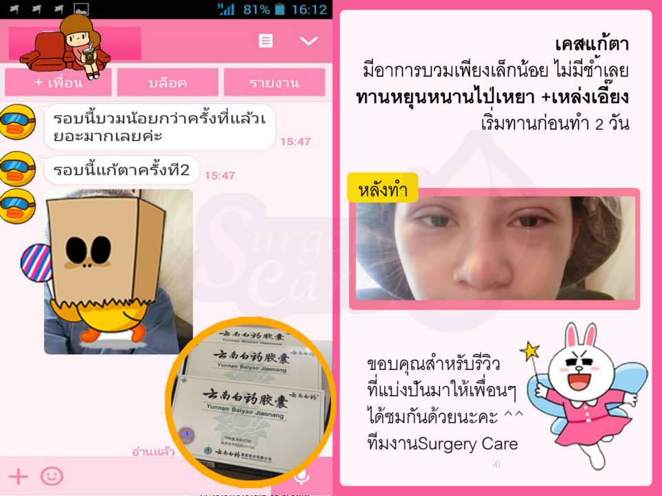 รีวิวทำตา,แก้ตา,ทำตา,ตา2ชั้น,รีวิวศัลยกรรมตา2ชั้น,รีวิวผ่าตา,รีวิวทำตา,รีวิวทำตาสองชั้น,รีวิวลดบวมช้ำ รีวิวศัลยกรรม,รีวิว, ศัลยกรรม, หยุนหนานไป๋เหยา, Yunnanpaiyao, เหล่งเอี้ยง, เหล่งเอี้ยงextra, surgerycare, review, รีวิวผ่าตัด