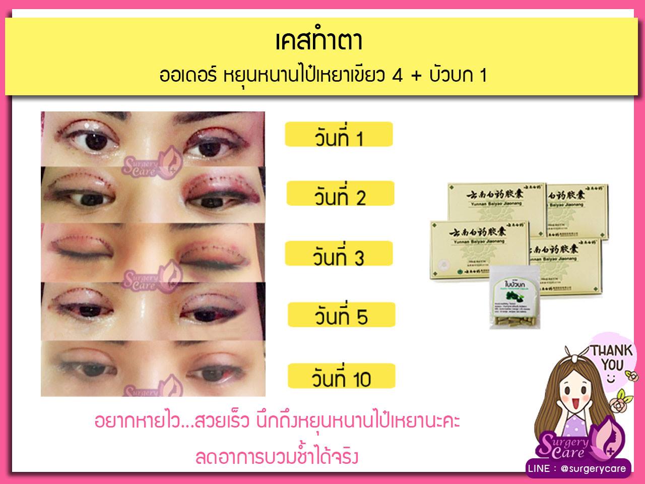 รีวิวทำตา,แก้ตา,ทำตา,ตา2ชั้น,รีวิวศัลยกรรมตา2ชั้น,รีวิวผ่าตา,รีวิวทำตา,รีวิวทำตาสองชั้น,รีวิวลดบวมช้ำ รีวิวศัลยกรรม,รีวิว, ศัลยกรรม, หยุนหนานไป๋เหยา, Yunnanpaiyao, เหล่งเอี้ยง, เหล่งเอี้ยงextra, surgerycare, review, รีวิวผ่าตัด