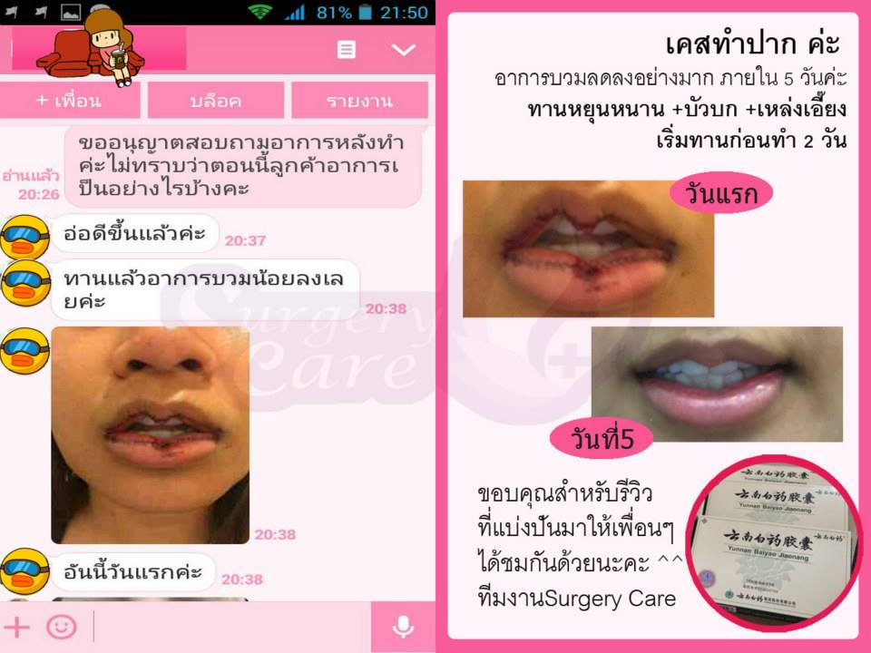 รีวิวตัดปาก,รีวิวทำปาก,รีวิวทำปากกระจับ, รีวิวหยุนหนานไป๋เหยา,รีวิวเหล่งเอี๊ยง,รีวิวสมุนไพร,รีวิวลดบวมช้ำ,รีวิวศัลยกรรม, รีวิวจมูก, รีวิวตา, รีวิวคาง , รีวิวเสริมหน้าอก, รีวิวดูดไขมัน, รีวิวศัลยกรรม, ฟิลเลอร์, ร้อยไหม, หยุนหนานไป๋เหยา ,Yunnanpaiyao, เหล่งเอี้ยงextra ,surgerycare, review, รีวิวผ่าตัด 
