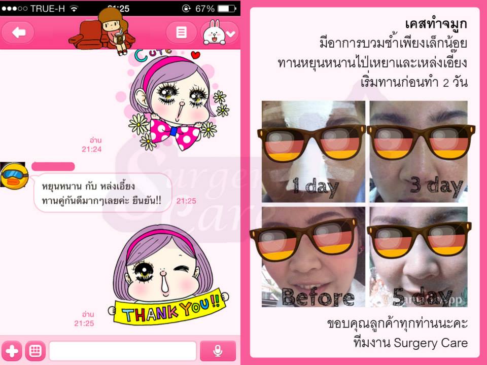 รีวิวแก้จมูก,รีวิวแก้จมูกขูดของเหลว,เหล่งเอี้ยง, เหล่งเอี้ยงextra, สมุนไพรจีน, ยาลดบวมช้ำศัลยกรรม, ลดปวด, ลดอักเสบ, สมานแผล, ทำศัยกรรมอยากหายไว, เหล่งเอี้ยงของแท้, เหล่งเอี้ยง, เหล่งเอี้ยงextra, แผลหายไว, พักฟื้น, เขียวช้ำ, ลดบวมซ้ำ, ฟื้นตัว, หายไว, ยาลดบวม, รีวิวดูดไขมัน,รีวิวทำหน้าวีเชฟ,รีวิวทุบหน้า, หยุนหนานไป๋เหยา, หยุนหนานไป๋เหยากล่องเขียว, Yunnanpaiyao, สมุนไพรจีน, ยาลดบวมช้ำศัลยกรรม, ทำศัยกรรมอยากหายไว, หยุนหนานไป๋หยาของแท้, Surgerycare,