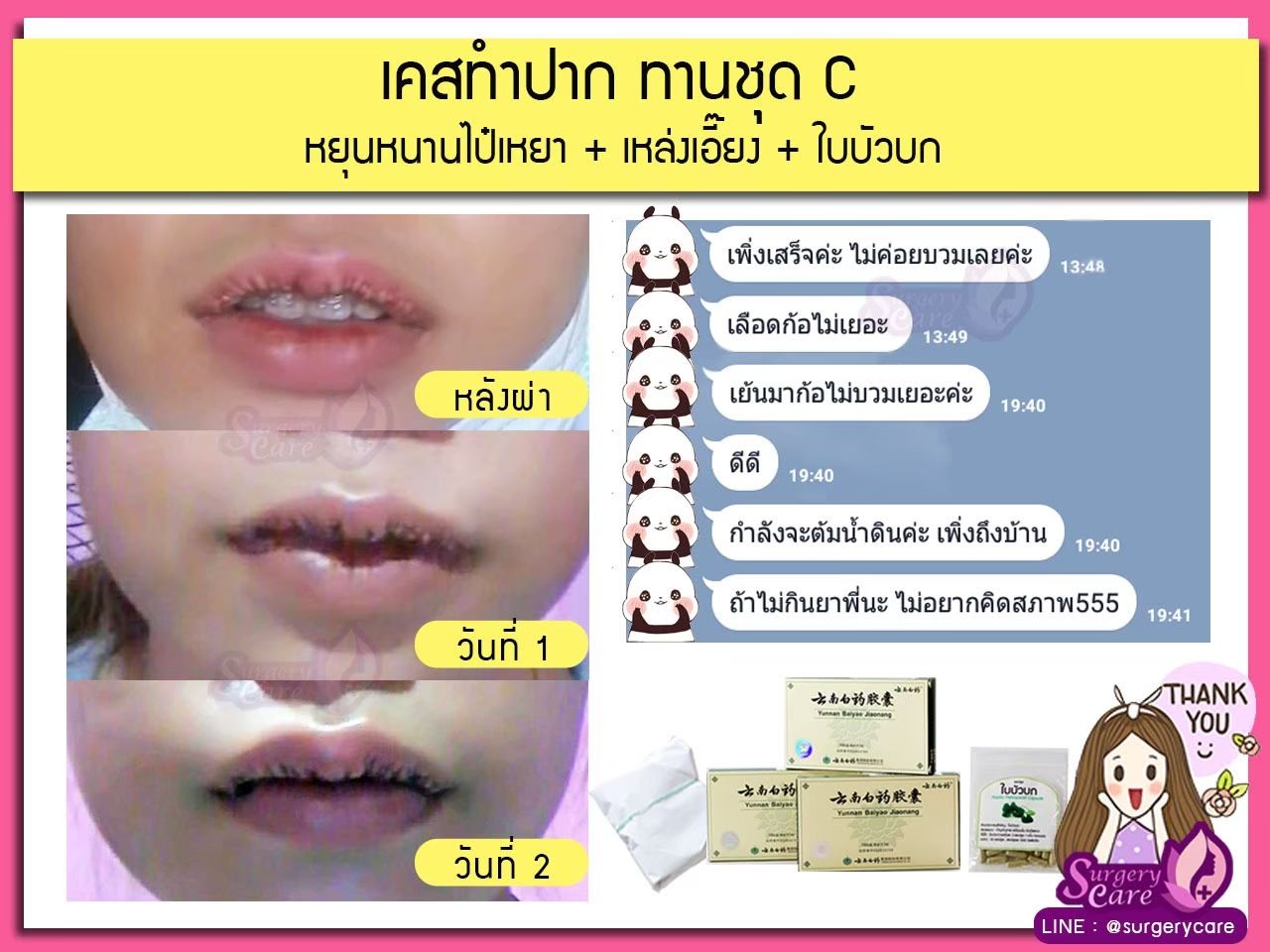 รีวิวทำปาก,รีวิวทำปากกระจับ, รีวิวหยุนหนานไป๋เหยา,รีวิวเหล่งเอี๊ยง,รีวิวสมุนไพร,รีวิวลดบวมช้ำ,รีวิวศัลยกรรม, รีวิวจมูก, รีวิวตา, รีวิวคาง , รีวิวเสริมหน้าอก, รีวิวดูดไขมัน, รีวิวศัลยกรรม, ฟิลเลอร์, ร้อยไหม, หยุนหนานไป๋เหยา ,Yunnanpaiyao, เหล่งเอี้ยงextra ,surgerycare, review, รีวิวผ่าตัด 