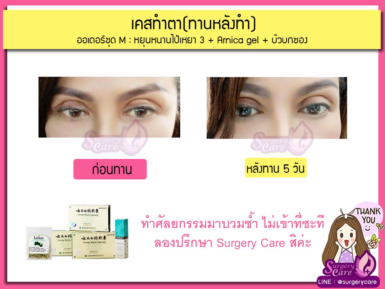 รีวิวทำตา,รีวิวทำตาสองชั้น,รีวิวลดบวมช้ำ รีวิวศัลยกรรม,รีวิว, ศัลยกรรม, หยุนหนานไป๋เหยา, Yunnanpaiyao, เหล่งเอี้ยง, เหล่งเอี้ยงextra, surgerycare, review, รีวิวผ่าตัด