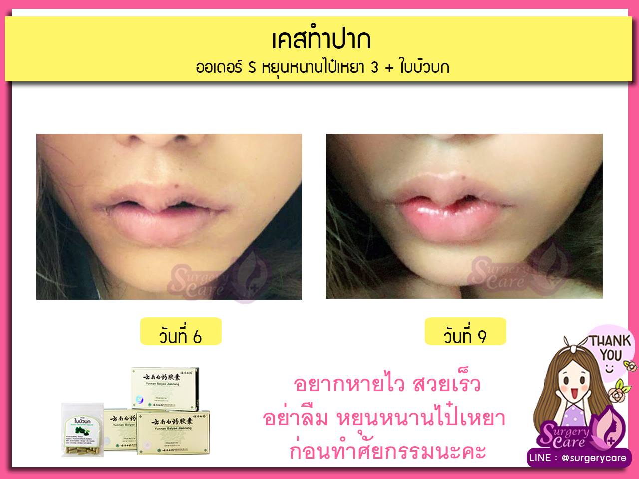 รีวิวตัดปาก,รีวิวทำปาก,รีวิวทำปากกระจับ, รีวิวหยุนหนานไป๋เหยา,รีวิวเหล่งเอี๊ยง,รีวิวสมุนไพร,รีวิวลดบวมช้ำ,รีวิวศัลยกรรม, รีวิวจมูก, รีวิวตา, รีวิวคาง , รีวิวเสริมหน้าอก, รีวิวดูดไขมัน, รีวิวศัลยกรรม, ฟิลเลอร์, ร้อยไหม, หยุนหนานไป๋เหยา ,Yunnanpaiyao, เหล่งเอี้ยงextra ,surgerycare, review, รีวิวผ่าตัด 