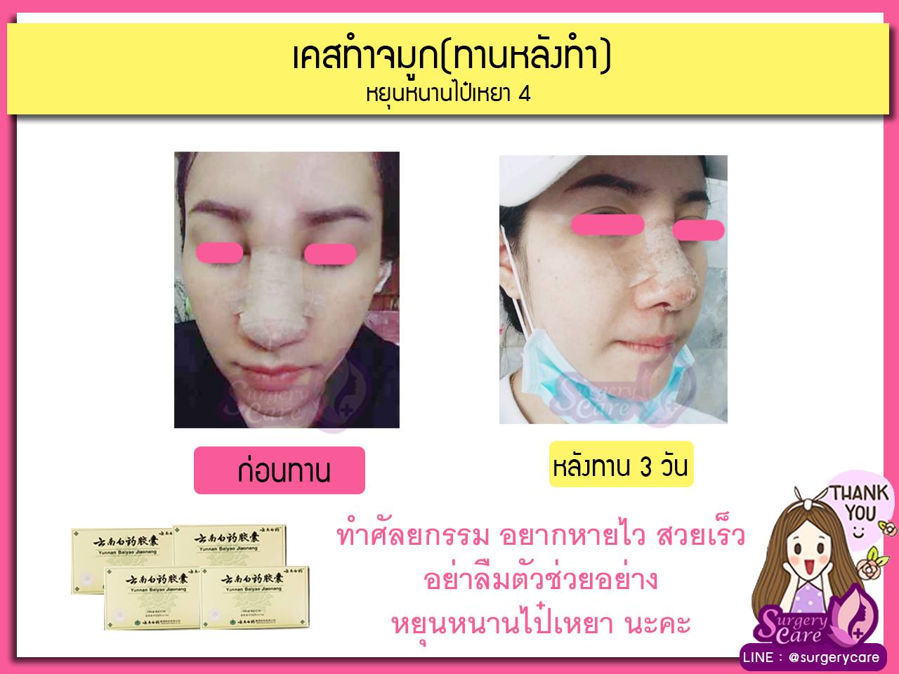 รีวิวจมูกทานหลังทำ,รีวิวจมูก,เหล่งเอี้ยง,เหล่งเอี้ยงextra ,สมุนไพรจีน,ยาลดบวมช้ำศัลยกรรม, ลดปวด, ลดอักเสบ, สมานแผล, ทำศัยกรรมอยากหายไว, เหล่งเอี้ยงของแท้, เหล่งเอี้ยง, เหล่งเอี้ยงextra, แผลหายไว, พักฟื้นน้อย, เขียวช้ำ, ลดบวมซ้ำ,ฟื้นตัวไว, หายไว, ยาลดบวม, หยุนหนานไป๋เหยา, หยุนหนานไป๋เหยากล่องเขียว, Yunnanpaiyao,สมุนไพรจีน, ยาลดบวมช้ำศัลยกรรม, ทำศัยกรรมอยากหายไว, หยุนหนานไป๋หยาของแท้, Surgerycare,