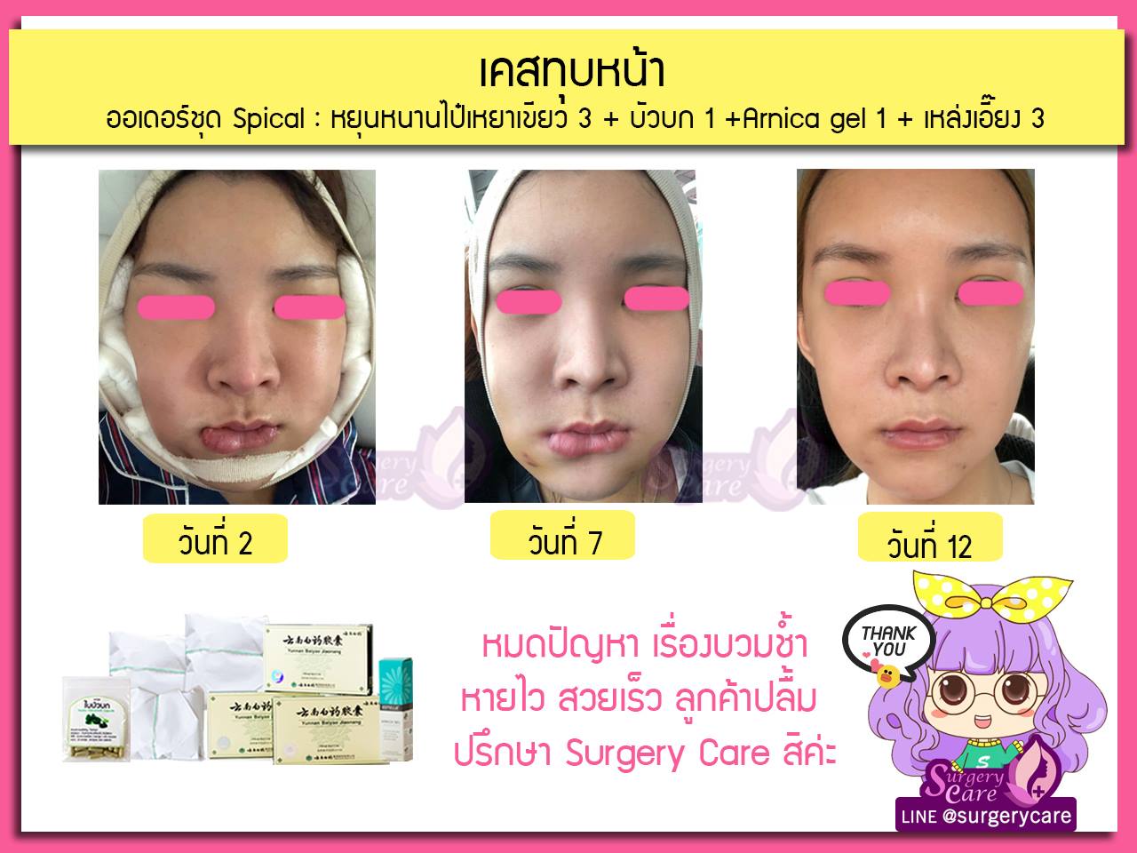 รีวิวทุบหน้า,หน้าวีเชฟ,เหล่งเอี้ยง, เหล่งเอี้ยงextra, สมุนไพรจีน, ยาลดบวมช้ำศัลยกรรม, ลดปวด, ลดอักเสบ, สมานแผล, ทำศัยกรรมอยากหายไว, เหล่งเอี้ยงของแท้, เหล่งเอี้ยง, เหล่งเอี้ยงextra, แผลหายไว, พักฟื้น, เขียวช้ำ, ลดบวมซ้ำ, ฟื้นตัว, หายไว, ยาลดบวม, รีวิวดูดไขมัน,รีวิวทำหน้าวีเชฟ,รีวิวทุบหน้า, หยุนหนานไป๋เหยา, หยุนหนานไป๋เหยากล่องเขียว, Yunnanpaiyao, สมุนไพรจีน, ยาลดบวมช้ำศัลยกรรม, ทำศัยกรรมอยากหายไว, หยุนหนานไป๋หยาของแท้, Surgerycare,
