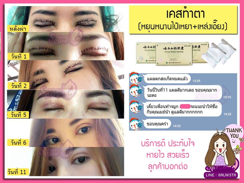 รีวิวศัลยกรรมตา2ชั้น,รีวิวผ่าตา,รีวิวทำตา,รีวิวทำตาสองชั้น,รีวิวลดบวมช้ำ รีวิวศัลยกรรม,รีวิว, ศัลยกรรม, หยุนหนานไป๋เหยา, Yunnanpaiyao, เหล่งเอี้ยง, เหล่งเอี้ยงextra, surgerycare, review, รีวิวผ่าตัด