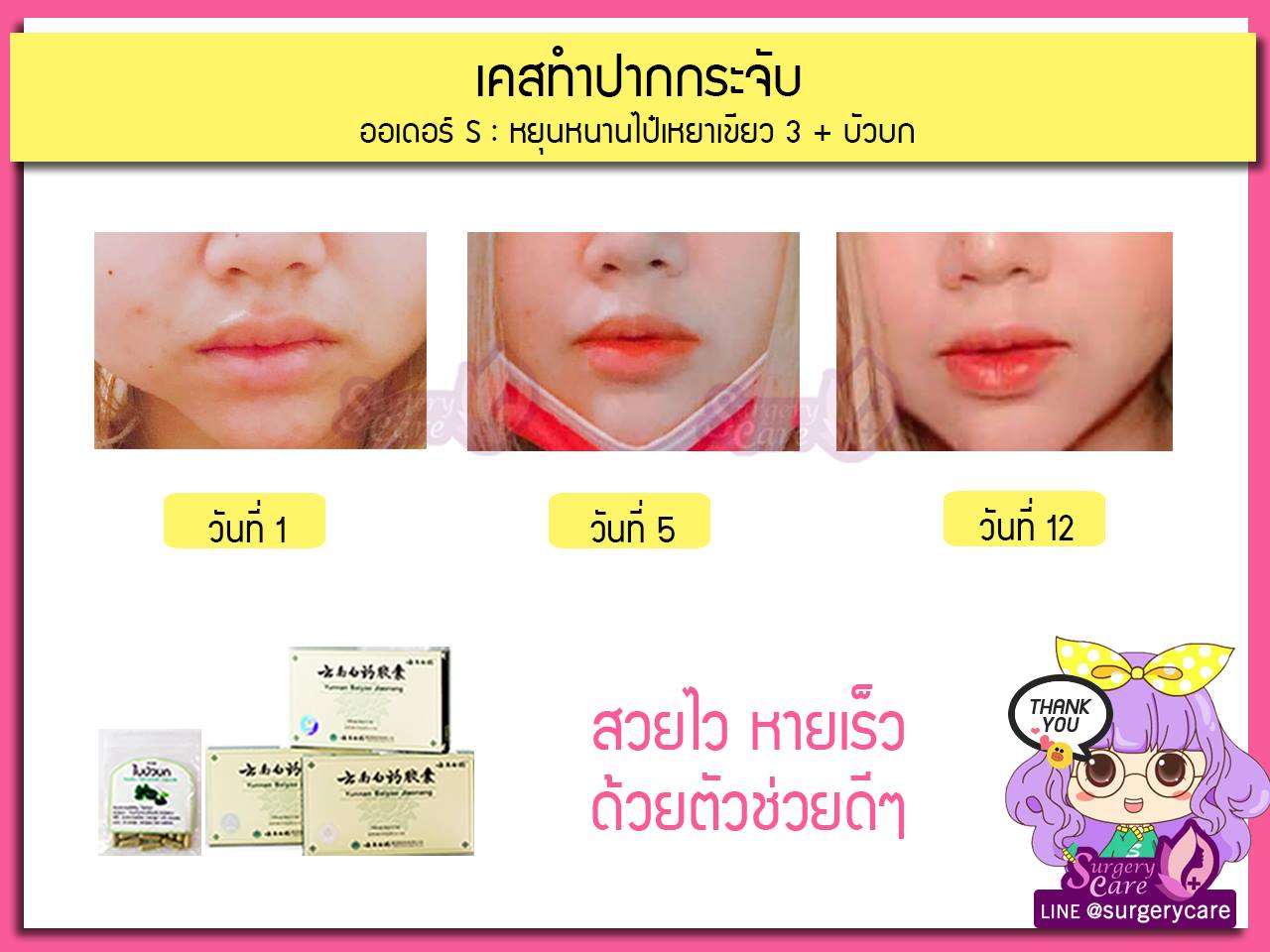 รีวิวตัดปาก,รีวิวทำปาก,รีวิวทำปากกระจับ, รีวิวหยุนหนานไป๋เหยา,รีวิวเหล่งเอี๊ยง,รีวิวสมุนไพร,รีวิวลดบวมช้ำ,รีวิวศัลยกรรม, รีวิวจมูก, รีวิวตา, รีวิวคาง , รีวิวเสริมหน้าอก, รีวิวดูดไขมัน, รีวิวศัลยกรรม, ฟิลเลอร์, ร้อยไหม, หยุนหนานไป๋เหยา ,Yunnanpaiyao, เหล่งเอี้ยงextra ,surgerycare, review, รีวิวผ่าตัด 