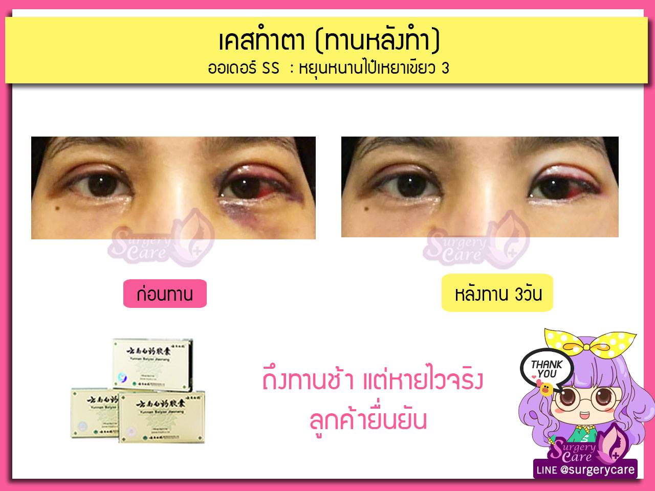 รีวิวหลังผ่า,รีวิวทำตา,บวมช้ำน้อย,หายไว,เหล่งเอี้ยง,เหล่งเอี้ยงextra ,สมุนไพรจีน,ยาลดบวมช้ำศัลยกรรม, ลดปวด, ลดอักเสบ, สมานแผล, ทำศัยกรรมอยากหายไว, เหล่งเอี้ยงของแท้, เหล่งเอี้ยง, เหล่งเอี้ยงextra, แผลหายไว, พักฟื้นน้อย, เขียวช้ำ, ลดบวมซ้ำ,ฟื้นตัวไว, หายไว, ยาลดบวม, หยุนหนานไป๋เหยา, หยุนหนานไป๋เหยากล่องเขียว, Yunnanpaiyao,สมุนไพรจีน, ยาลดบวมช้ำศัลยกรรม, ทำศัยกรรมอยากหายไว, หยุนหนานไป๋หยาของแท้, Surgerycare,