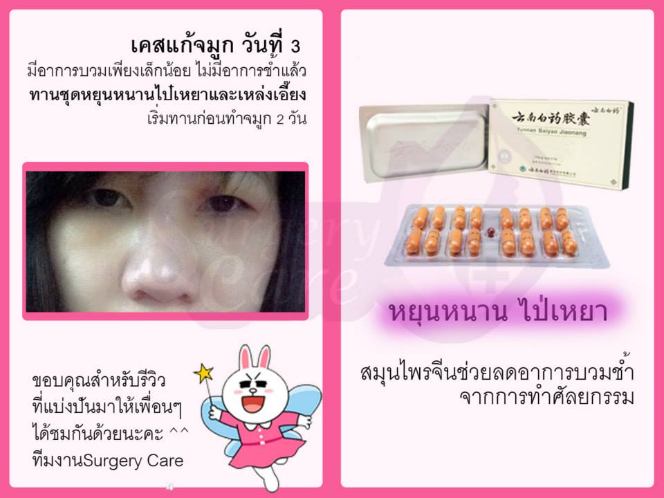ทำจมูก,เสริมจมูก,แก้จมูก,รีวิวจมูก,รีวิวแก้จมูก,รีวิวเสริมจมูก,เหล่งเอี้ยง, เหล่งเอี้ยงextra, สมุนไพรจีน, ยาลดบวมช้ำศัลยกรรม, ลดปวด, ลดอักเสบ, สมานแผล, ทำศัยกรรมอยากหายไว, เหล่งเอี้ยงของแท้, เหล่งเอี้ยง, เหล่งเอี้ยงextra, แผลหายไว, พักฟื้น, เขียวช้ำ, ลดบวมซ้ำ, ฟื้นตัว, หายไว, ยาลดบวม, รีวิวดูดไขมัน,รีวิวทำหน้าวีเชฟ,รีวิวทุบหน้า, หยุนหนานไป๋เหยา, หยุนหนานไป๋เหยากล่องเขียว, Yunnanpaiyao, สมุนไพรจีน, ยาลดบวมช้ำศัลยกรรม, ทำศัยกรรมอยากหายไว, หยุนหนานไป๋หยาของแท้, Surgerycare,