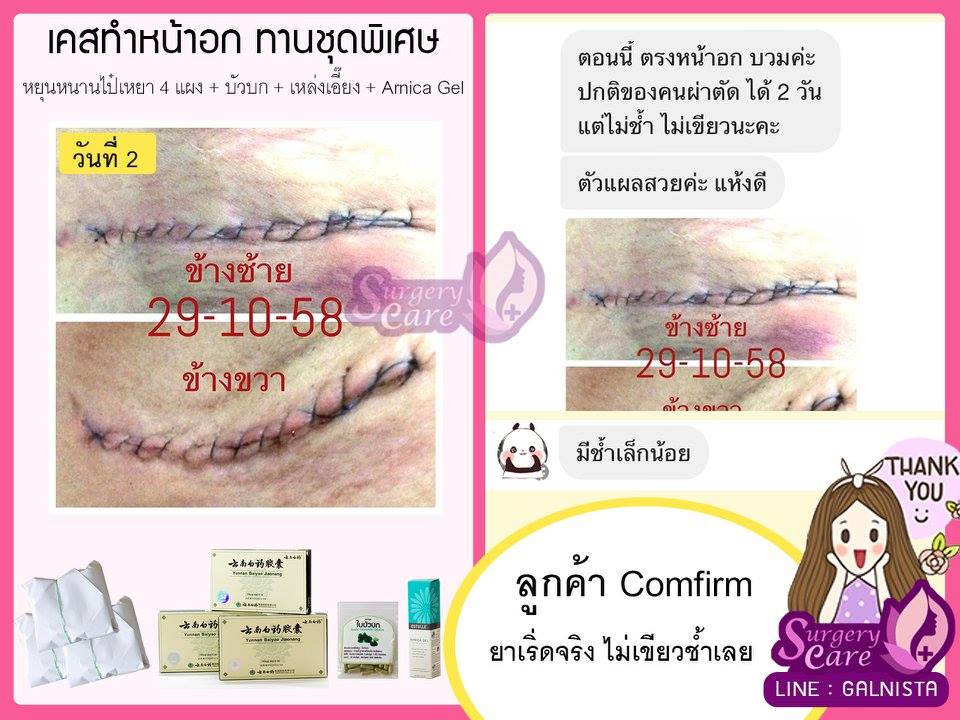 อัพไซส์,ทำหน้าอก,รีวิวเสริมหน้าอก,รีวิวทำนม,รีวิวหยุนหนานไป๋เหยา, รีวิวเหล่งเอี้ยง, รีวิวบัวบก, รีวิวสมุนไพร, รีวิวลดบวมช้ำ, รีวิวศัลยกรรม,รีวิว ศัลยกรรม, ฟิลเลอร์, ร้อยไหม, หยุนหนานไป๋เหยา, Yunnanpaiyao, เหล่งเอี้ยง, เหล่งเอี้ยงextra, surgerycare review ,รีวิวผ่าตัด , อัพไซส์,ทำหน้าอก,รีวิวเสริมหน้าอก,รีวิวทำนม,รีวิวหยุนหนานไป๋เหยา, รีวิวเหล่งเอี้ยง, รีวิวบัวบก, รีวิวสมุนไพร, รีวิวลดบวมช้ำ, รีวิวศัลยกรรม,รีวิว ศัลยกรรม, ฟิลเลอร์, ร้อยไหม, หยุนหนานไป๋เหยา, Yunnanpaiyao, เหล่งเอี้ยง, เหล่งเอี้ยงextra, surgerycare review ,รีวิวผ่าตัด ,