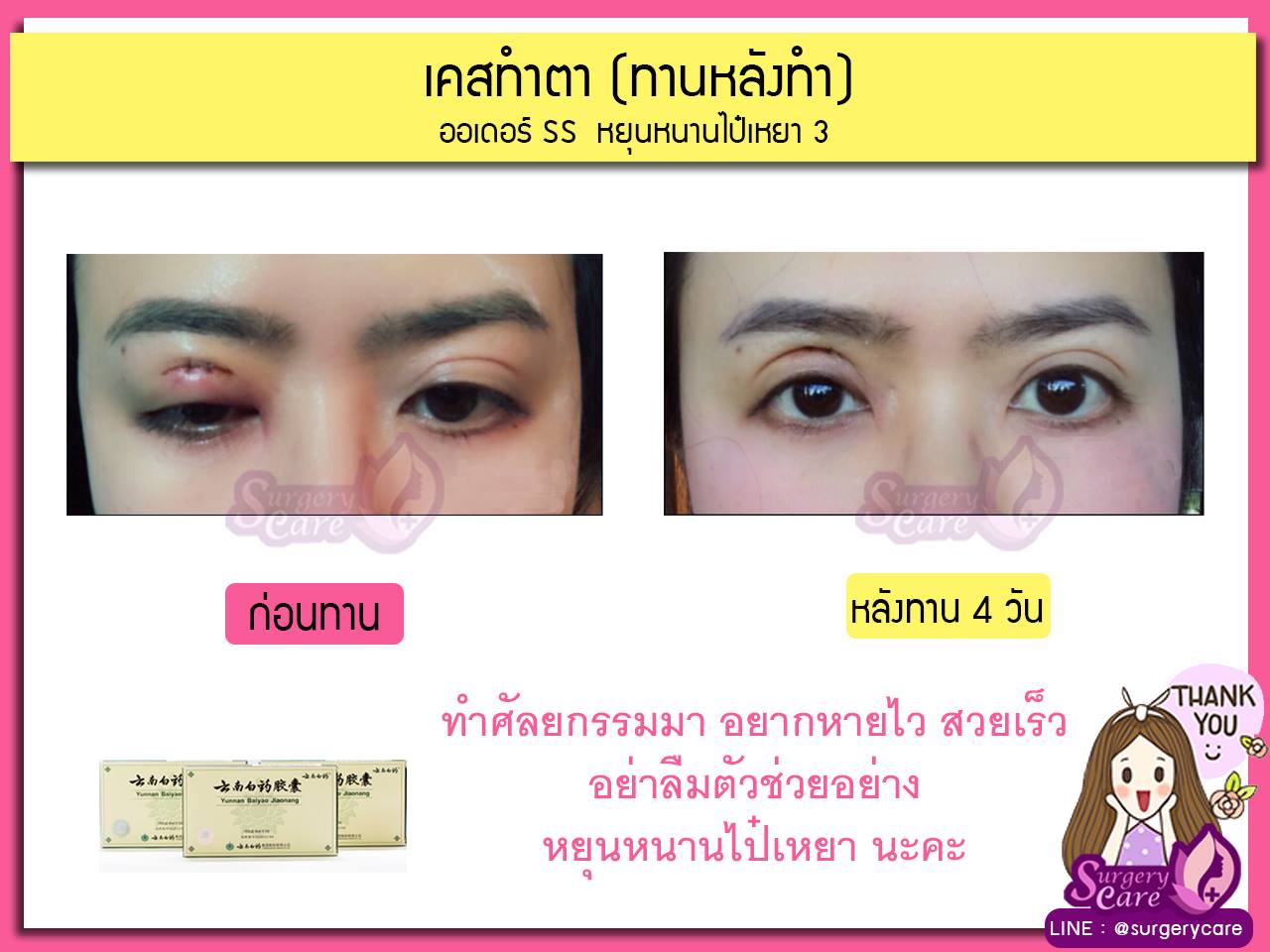 รีวิวหลังผ่า,รีวิวทำตา,บวมช้ำน้อย,หายไว,เหล่งเอี้ยง,เหล่งเอี้ยงextra ,สมุนไพรจีน,ยาลดบวมช้ำศัลยกรรม, ลดปวด, ลดอักเสบ, สมานแผล, ทำศัยกรรมอยากหายไว, เหล่งเอี้ยงของแท้, เหล่งเอี้ยง, เหล่งเอี้ยงextra, แผลหายไว, พักฟื้นน้อย, เขียวช้ำ, ลดบวมซ้ำ,ฟื้นตัวไว, หายไว, ยาลดบวม, หยุนหนานไป๋เหยา, หยุนหนานไป๋เหยากล่องเขียว, Yunnanpaiyao,สมุนไพรจีน, ยาลดบวมช้ำศัลยกรรม, ทำศัยกรรมอยากหายไว, หยุนหนานไป๋หยาของแท้, Surgerycare,