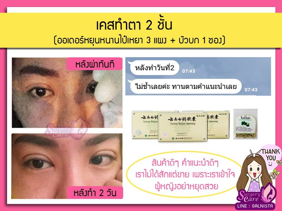 รีวิวทำตา,รีวิวลดบวมช้ำ รีวิวศัลยกรรม,รีวิว, ศัลยกรรม, หยุนหนานไป๋เหยา, Yunnanpaiyao, เหล่งเอี้ยง, เหล่งเอี้ยงextra, surgerycare, review, รีวิวผ่าตัด