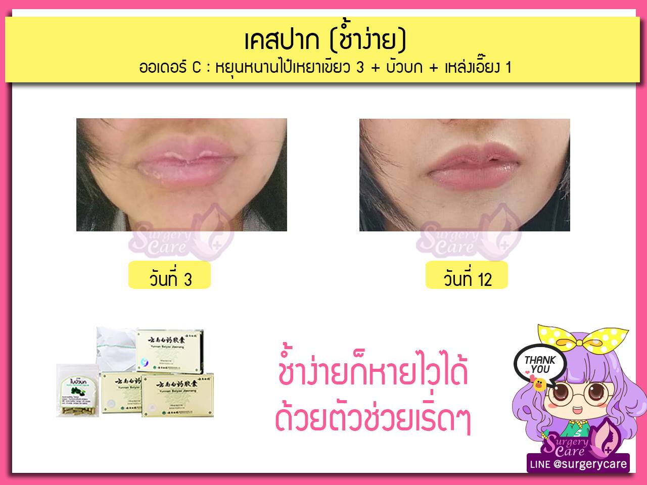 รีวิวตัดปาก,รีวิวทำปาก,รีวิวทำปากกระจับ, รีวิวหยุนหนานไป๋เหยา,รีวิวเหล่งเอี๊ยง,รีวิวสมุนไพร,รีวิวลดบวมช้ำ,รีวิวศัลยกรรม, รีวิวจมูก, รีวิวตา, รีวิวคาง , รีวิวเสริมหน้าอก, รีวิวดูดไขมัน, รีวิวศัลยกรรม, ฟิลเลอร์, ร้อยไหม, หยุนหนานไป๋เหยา ,Yunnanpaiyao, เหล่งเอี้ยงextra ,surgerycare, review, รีวิวผ่าตัด 