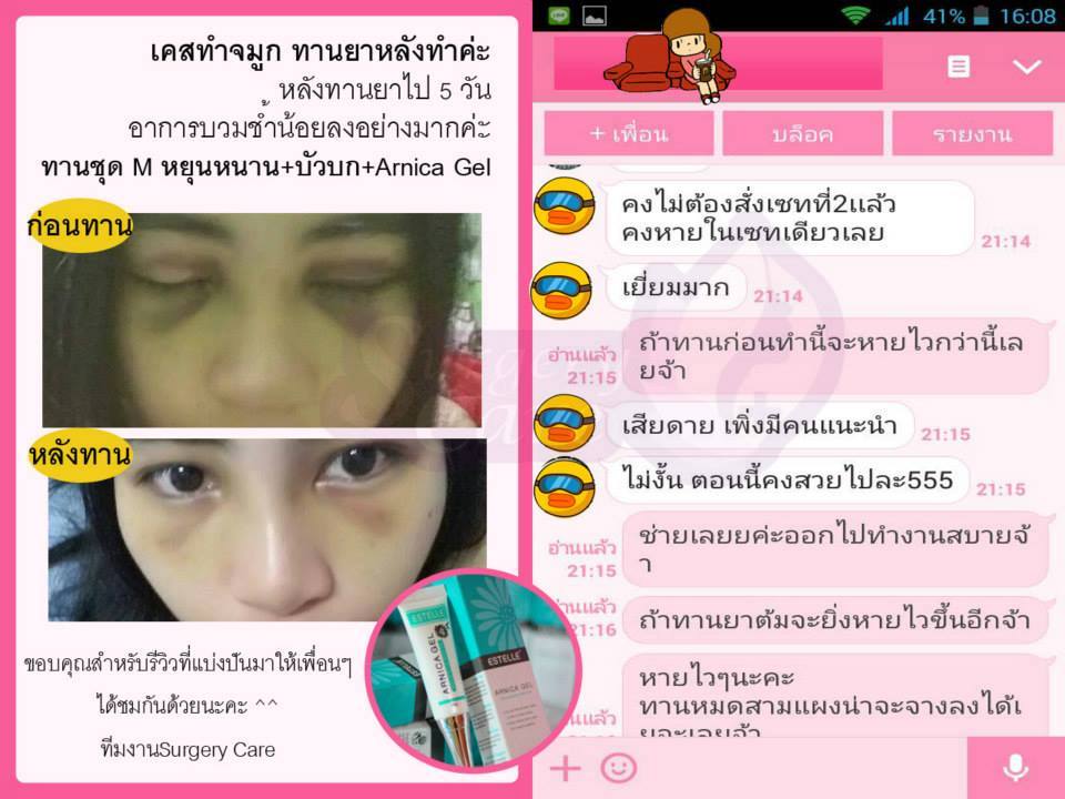 รีวิวจมูกทานหลังทำ,รีวิวจมูก,เหล่งเอี้ยง,เหล่งเอี้ยงextra ,สมุนไพรจีน,ยาลดบวมช้ำศัลยกรรม, ลดปวด, ลดอักเสบ, สมานแผล, ทำศัยกรรมอยากหายไว, เหล่งเอี้ยงของแท้, เหล่งเอี้ยง, เหล่งเอี้ยงextra, แผลหายไว, พักฟื้นน้อย, เขียวช้ำ, ลดบวมซ้ำ,ฟื้นตัวไว, หายไว, ยาลดบวม, หยุนหนานไป๋เหยา, หยุนหนานไป๋เหยากล่องเขียว, Yunnanpaiyao,สมุนไพรจีน, ยาลดบวมช้ำศัลยกรรม, ทำศัยกรรมอยากหายไว, หยุนหนานไป๋หยาของแท้, Surgerycare,