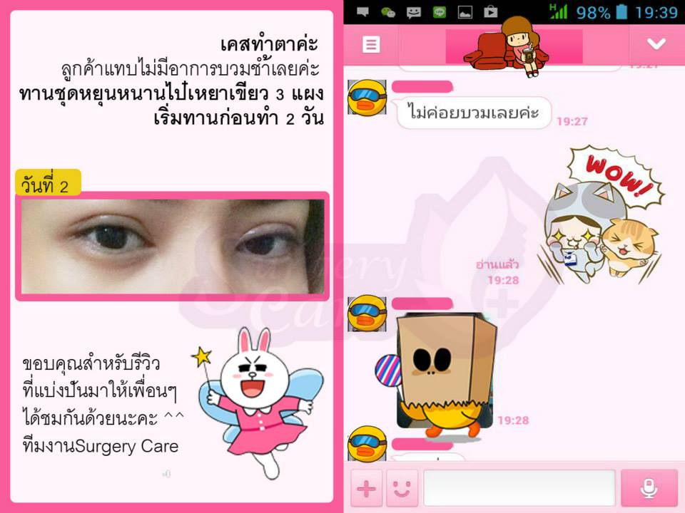 รีวิวทำตา,แก้ตา,ทำตา,ตา2ชั้น,รีวิวศัลยกรรมตา2ชั้น,รีวิวผ่าตา,รีวิวทำตา,รีวิวทำตาสองชั้น,รีวิวลดบวมช้ำ รีวิวศัลยกรรม,รีวิว, ศัลยกรรม, หยุนหนานไป๋เหยา, Yunnanpaiyao, เหล่งเอี้ยง, เหล่งเอี้ยงextra, surgerycare, review, รีวิวผ่าตัด